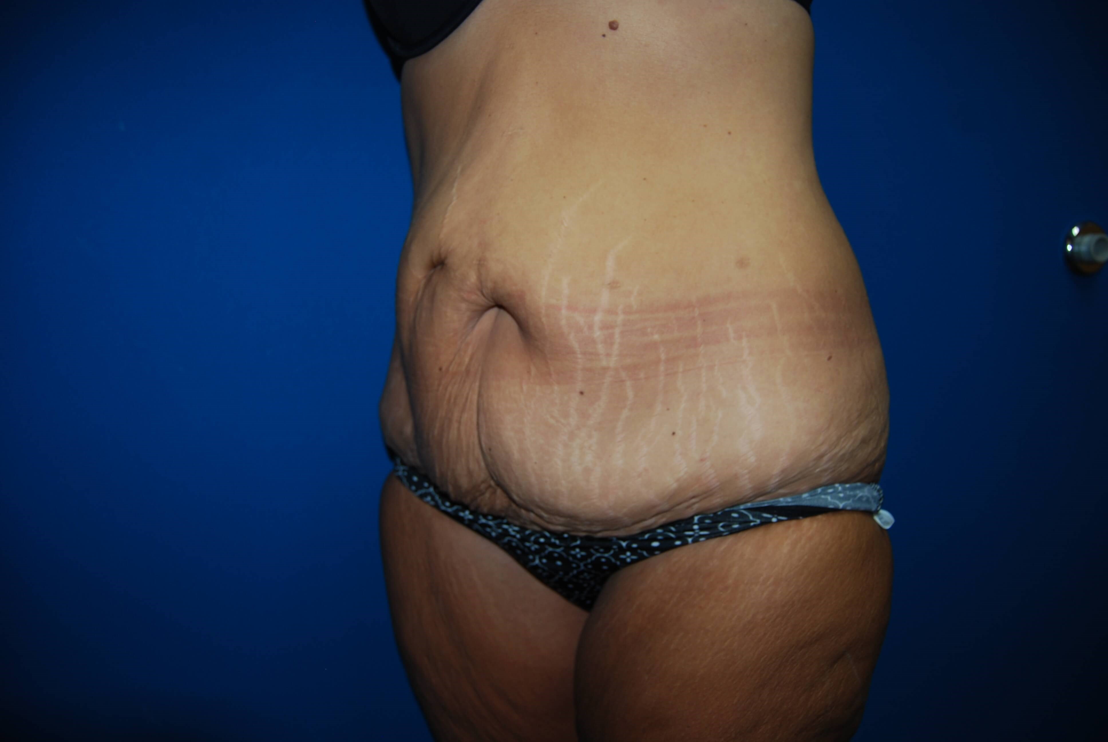 Oblique - Left Before