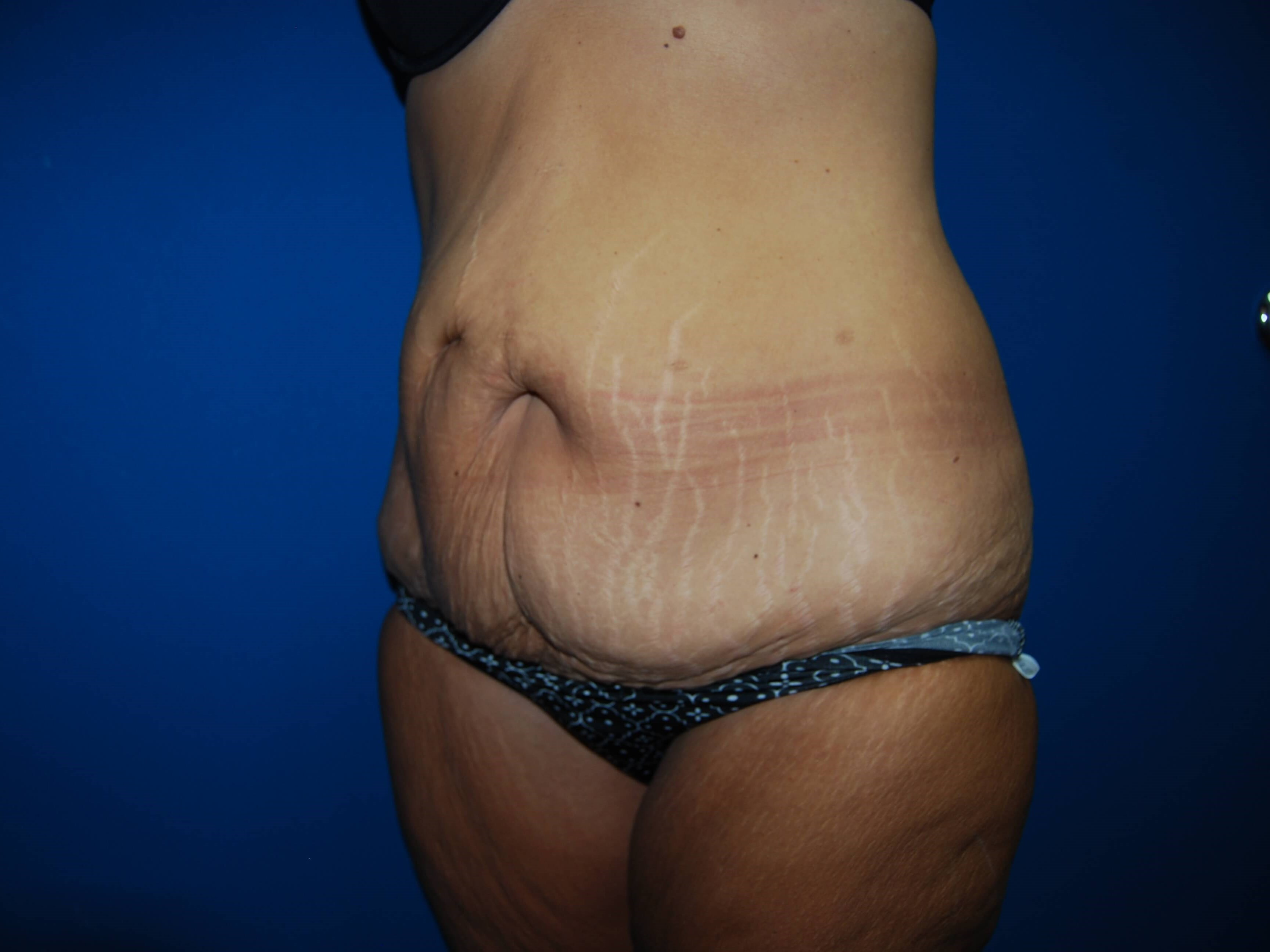 Oblique - Left Before