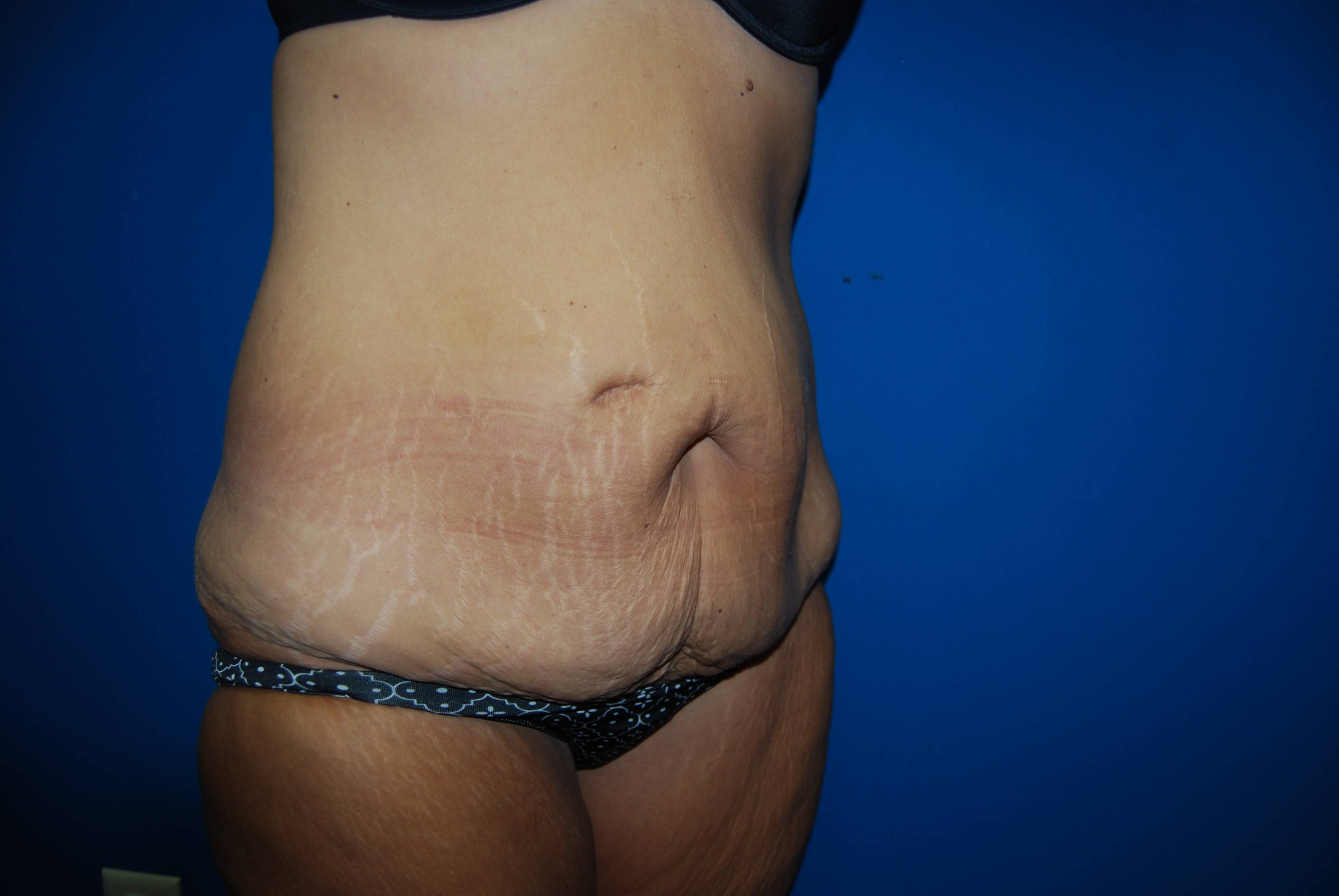 Oblique - Right Before