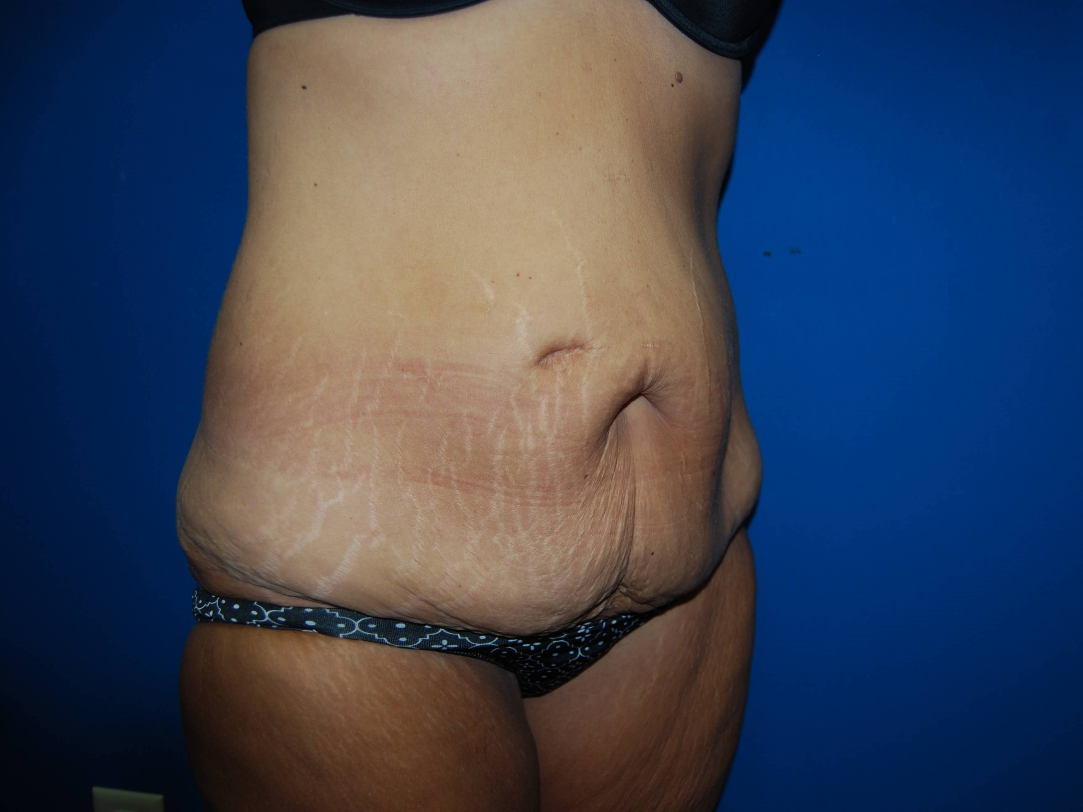 Oblique - Right Before