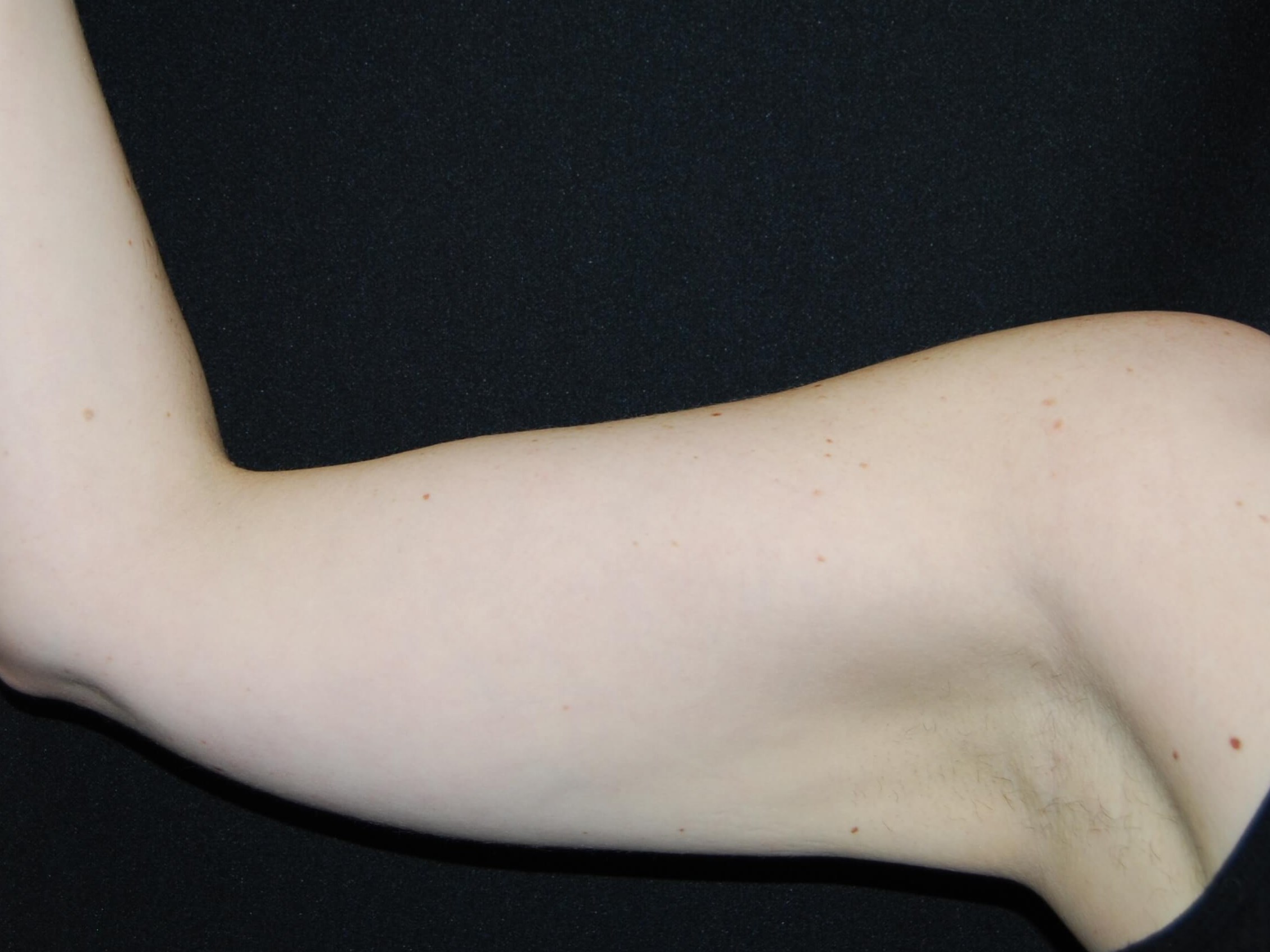 Coolsculpting Non-Surgical Fat After