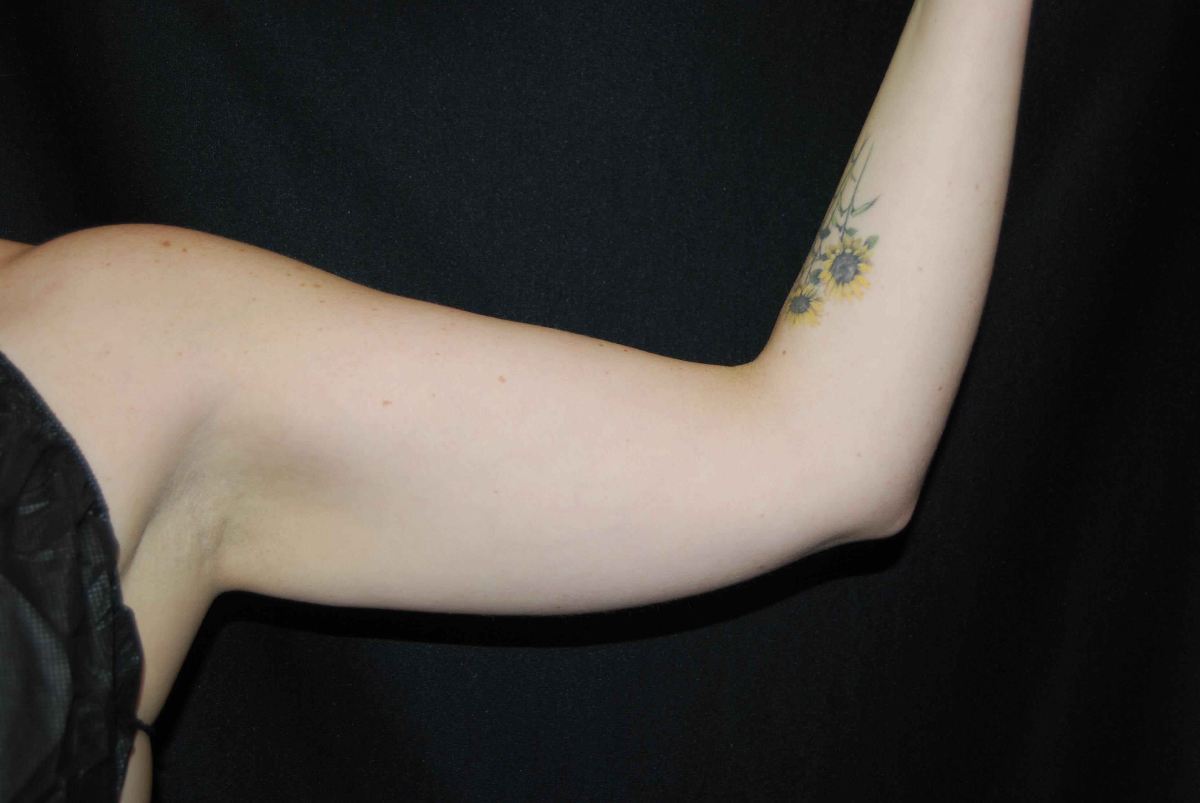 Coolsculpting Non-Surgical Fat Before