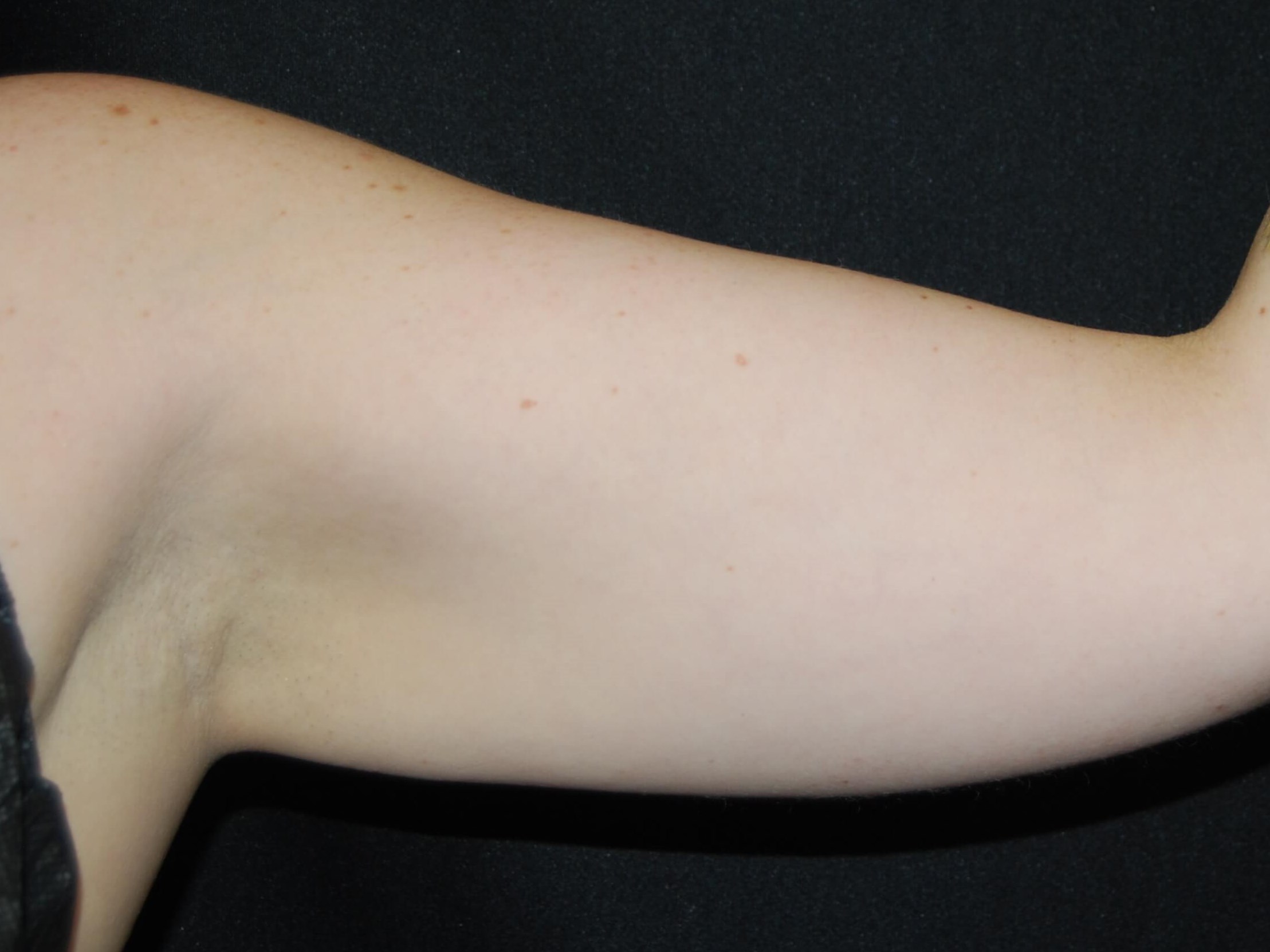 Coolsculpting Non-Surgical Fat Before