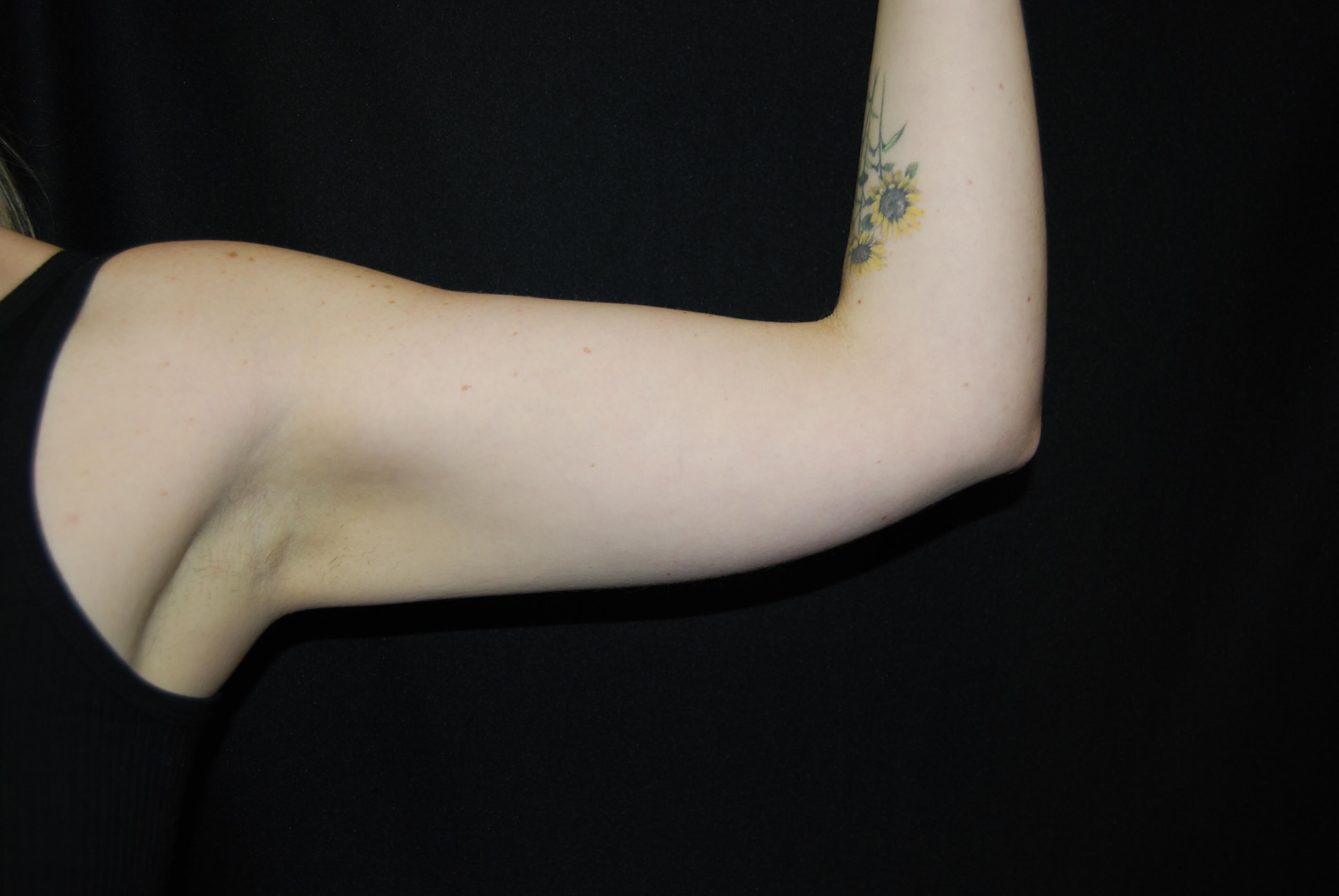 Coolsculpting Non-Surgical Fat After