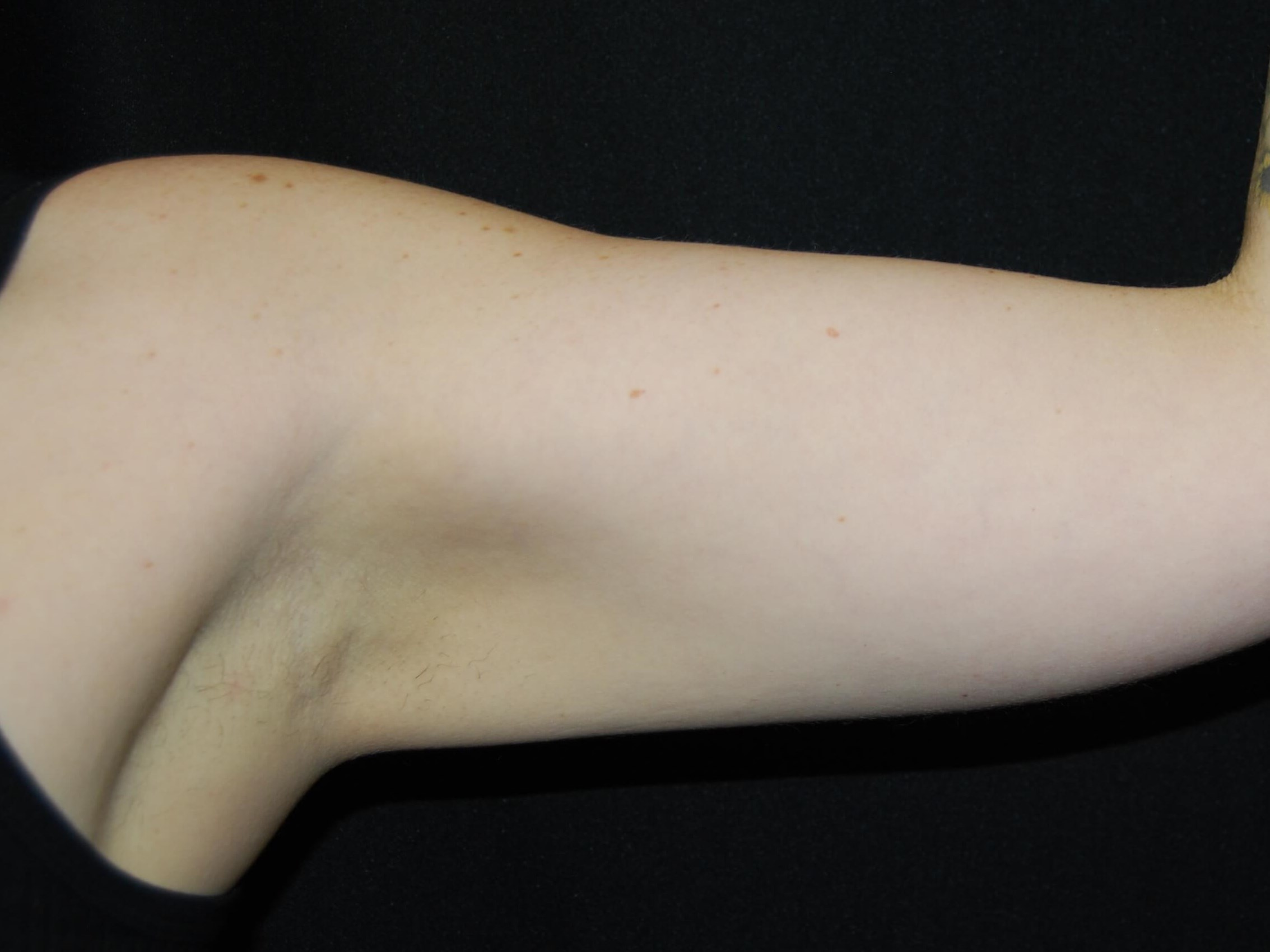 Coolsculpting Non-Surgical Fat After
