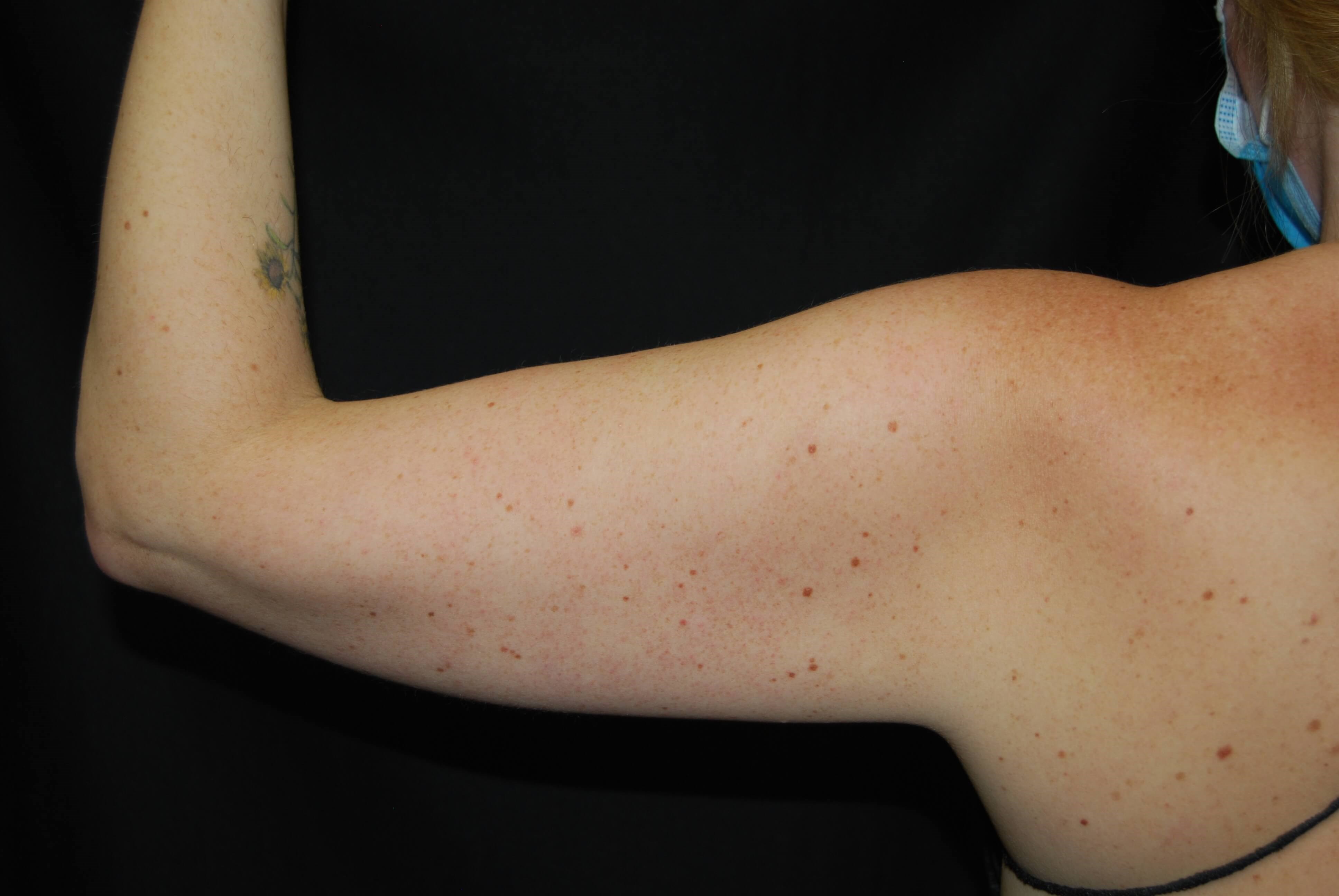 Coolsculpting Non-Surgical Fat Before