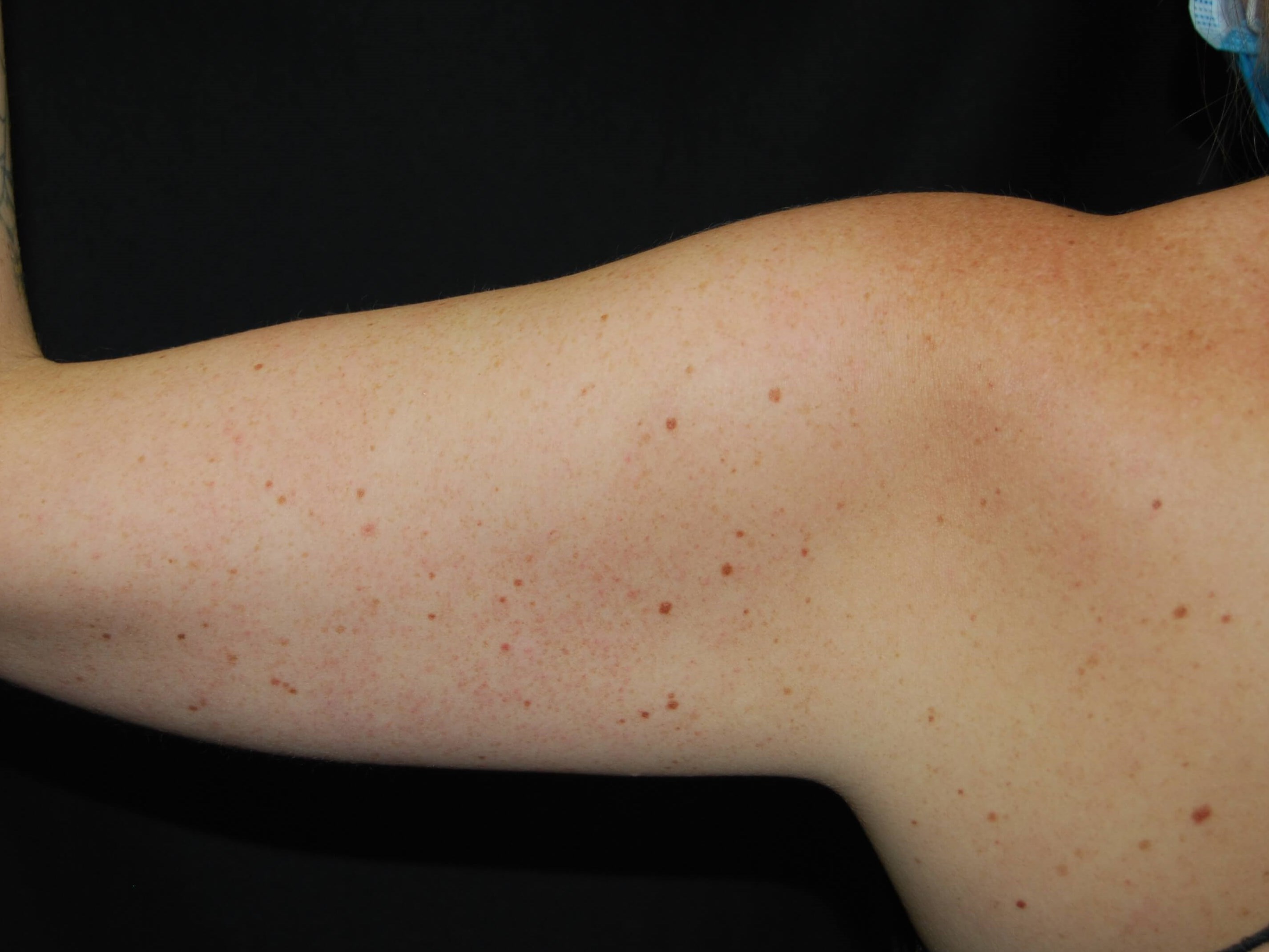 Coolsculpting Non-Surgical Fat Before