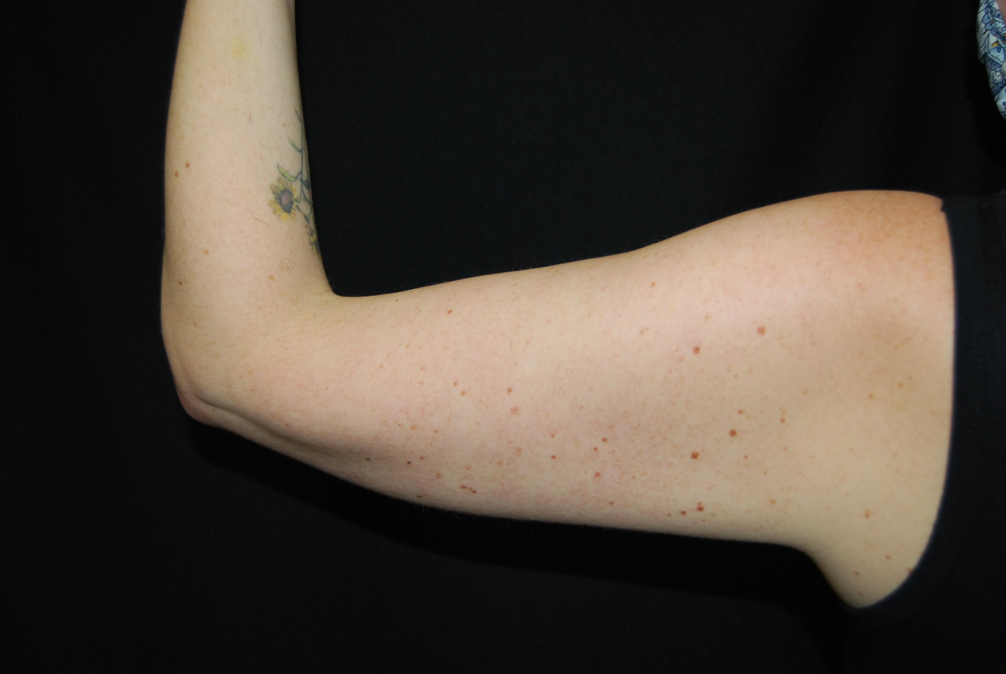 Coolsculpting Non-Surgical Fat After