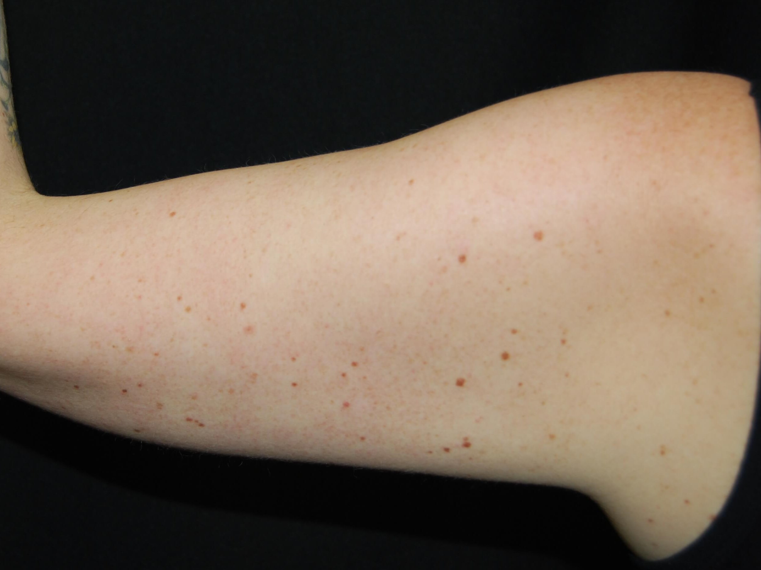 Coolsculpting Non-Surgical Fat After