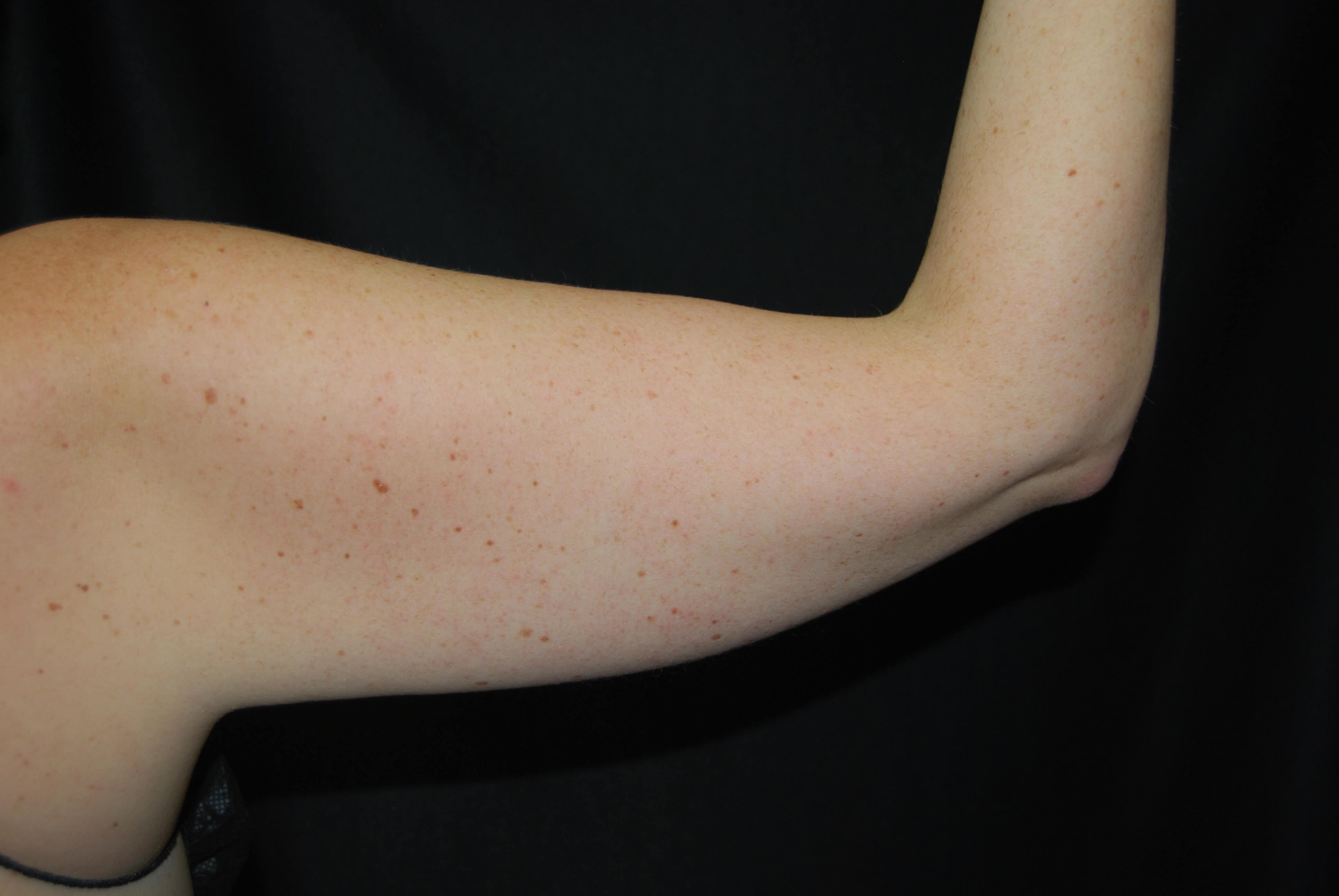 Coolsculpting Non-Surgical Fat Before