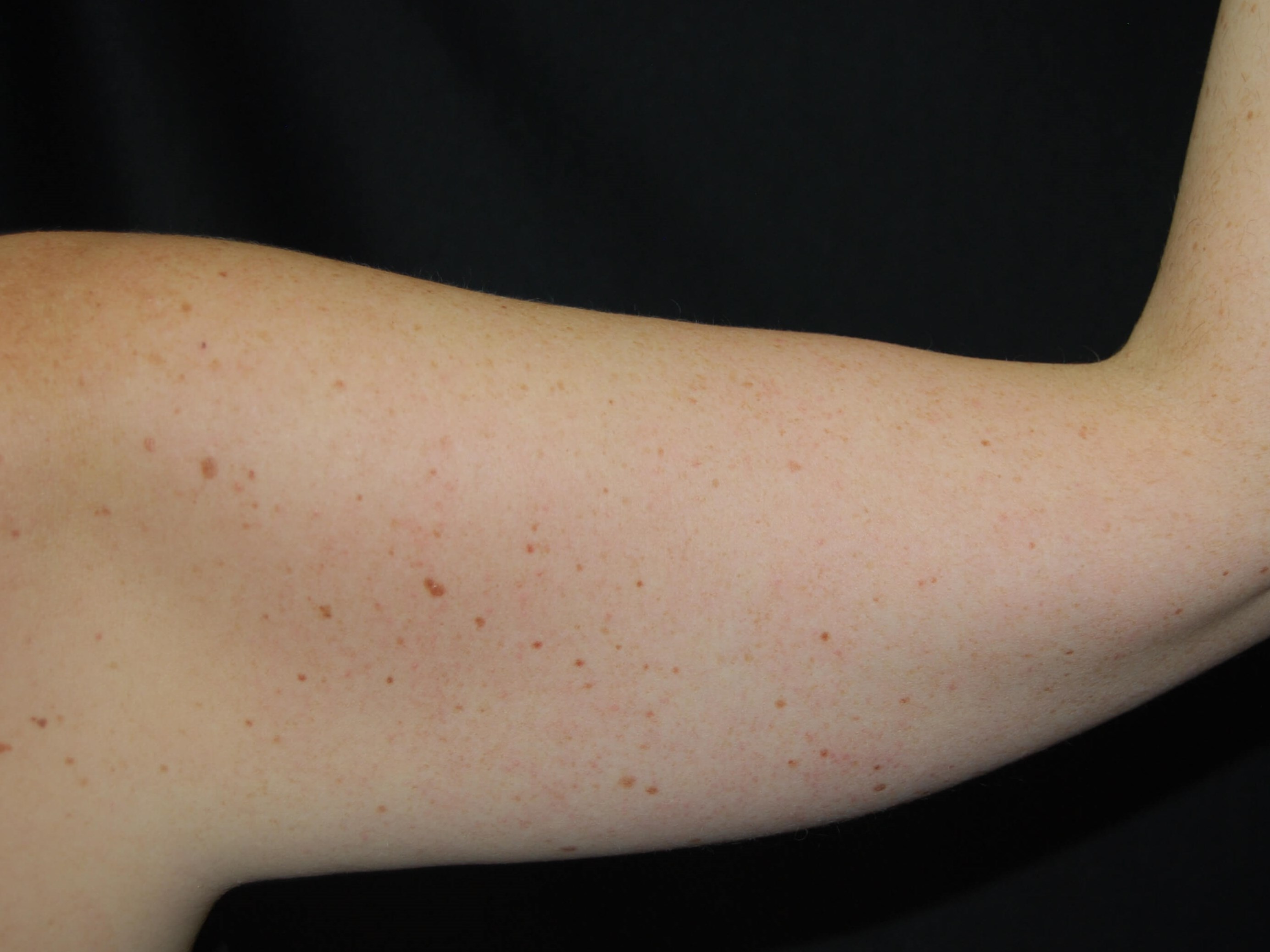 Coolsculpting Non-Surgical Fat Before
