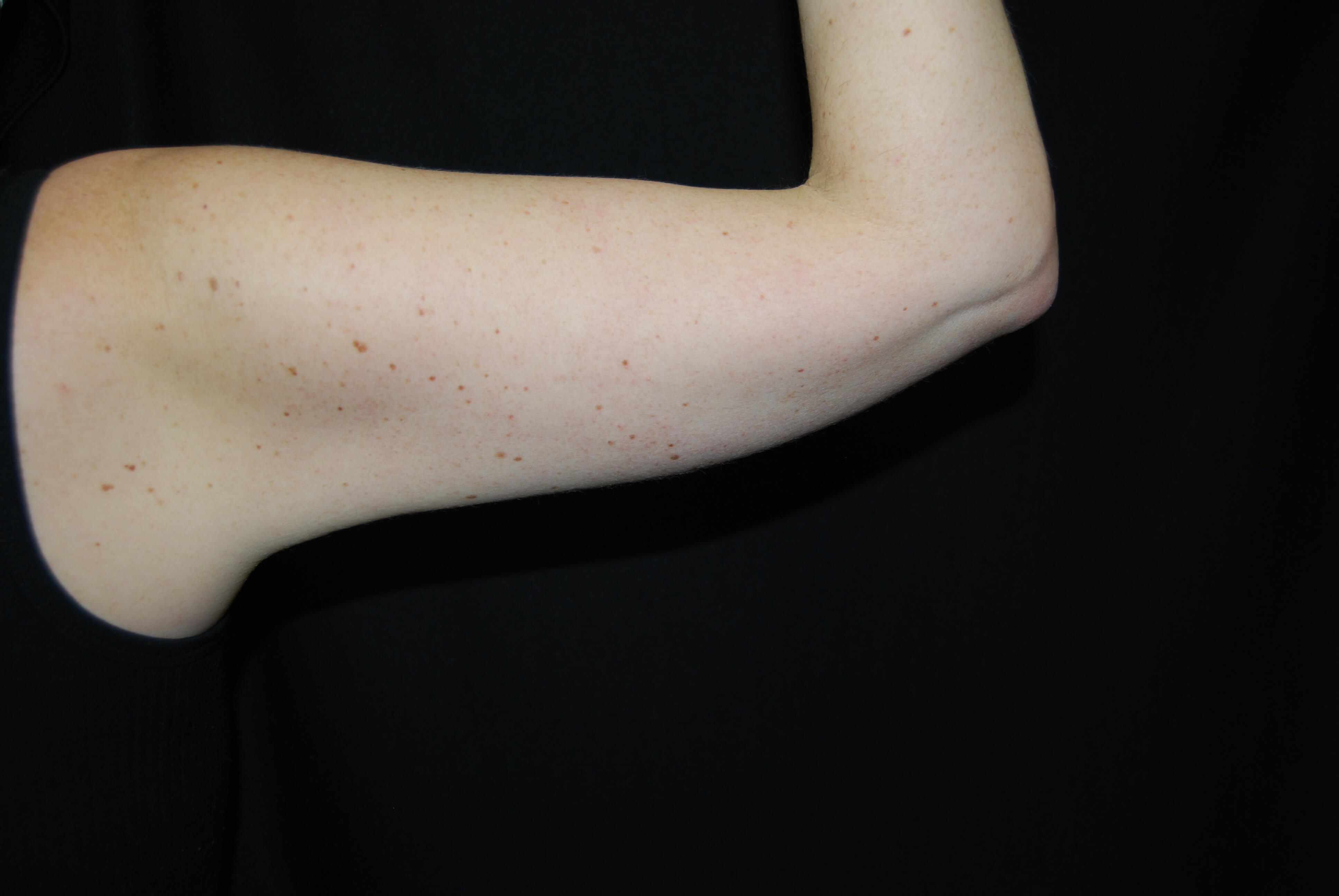 Coolsculpting Non-Surgical Fat After