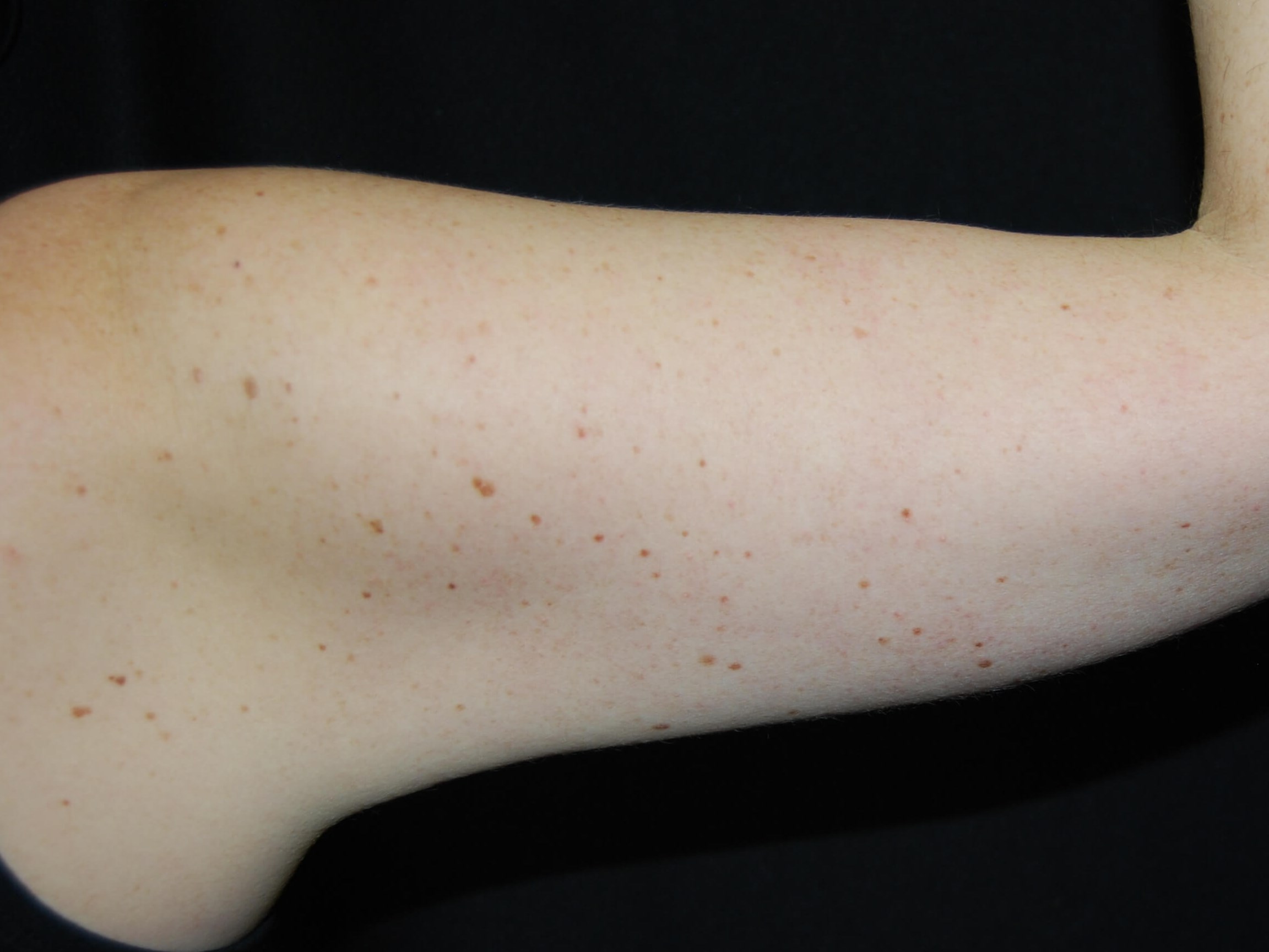 Coolsculpting Non-Surgical Fat After