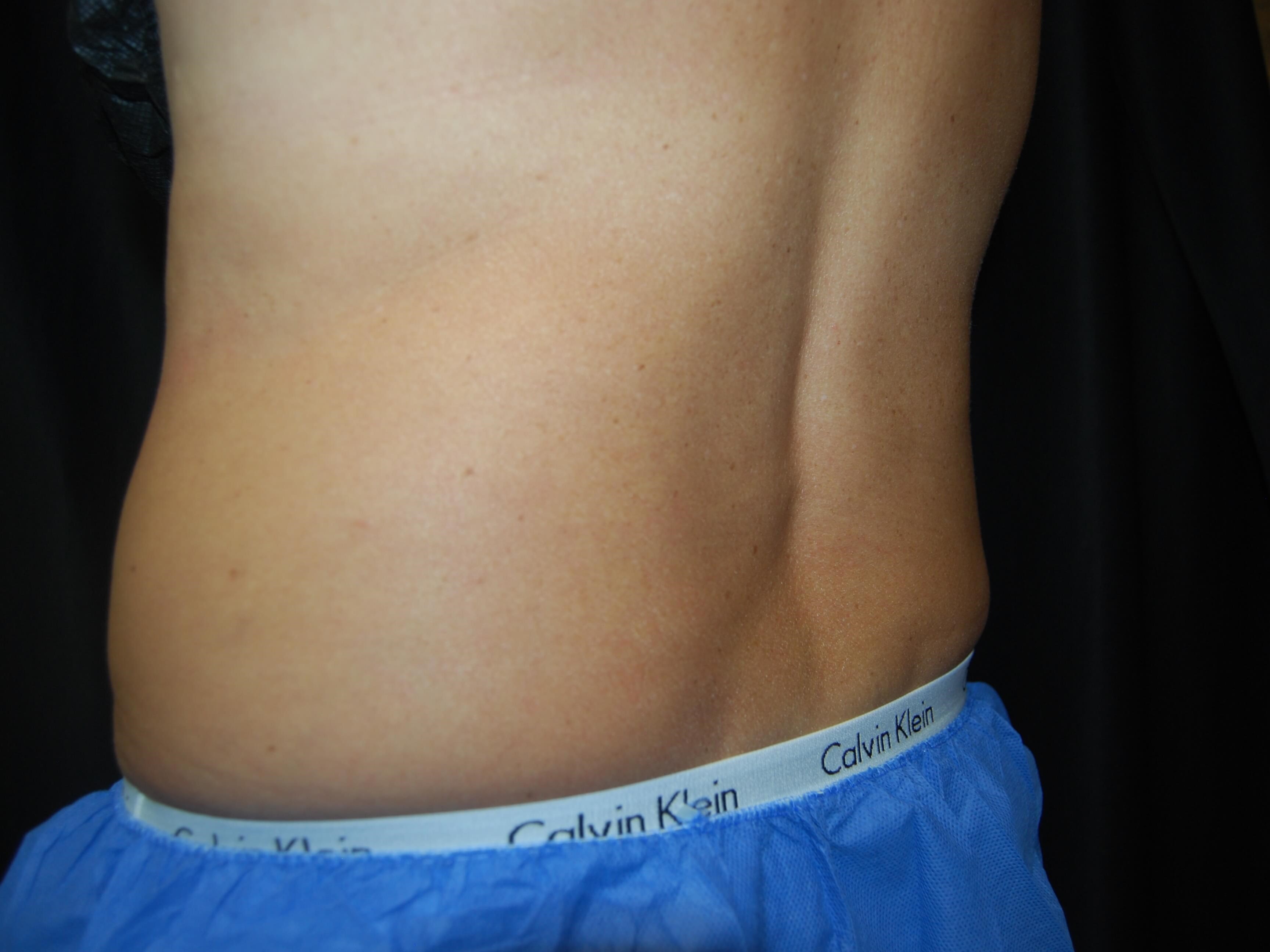 Coolsculpting Flanks After