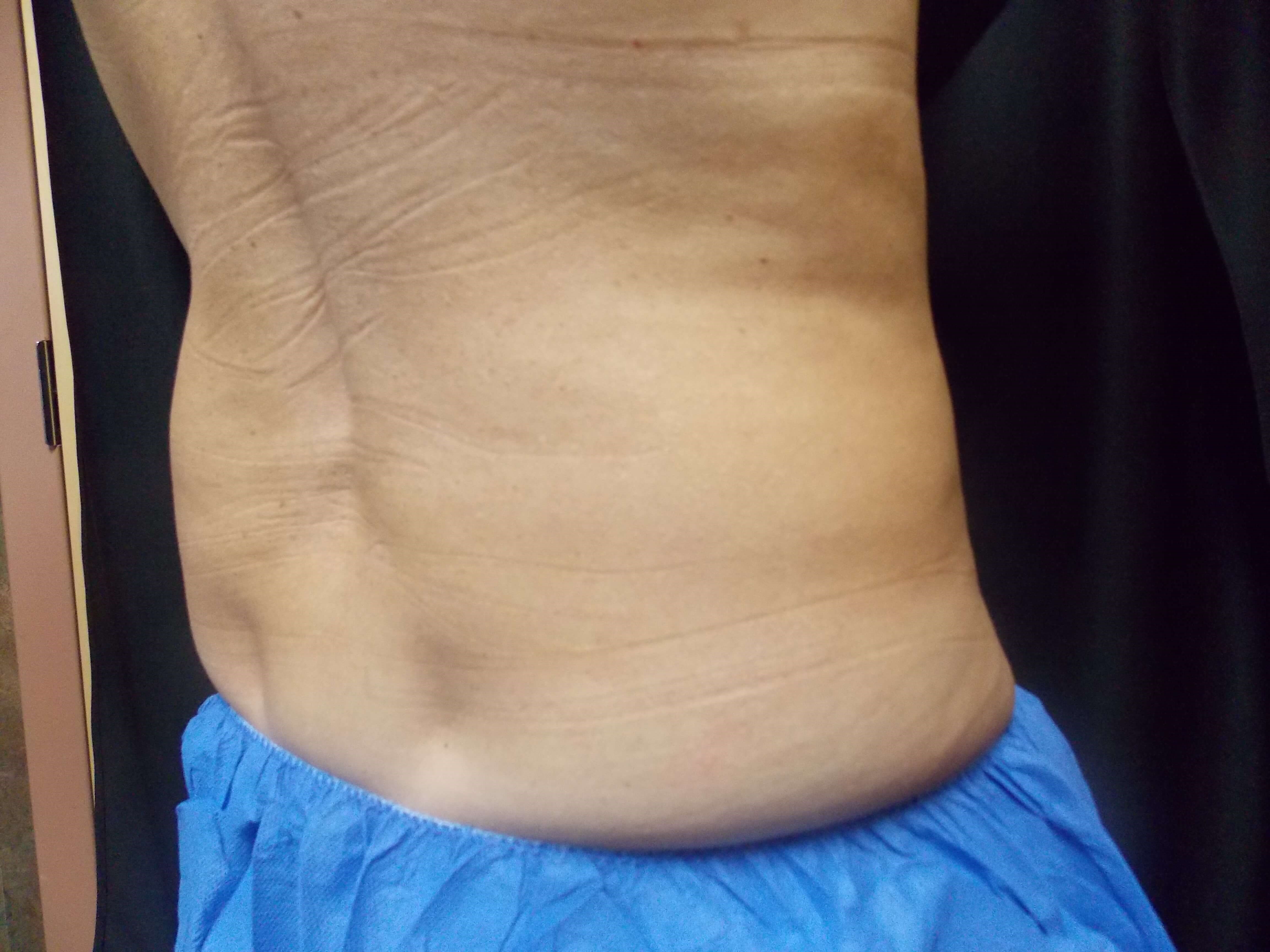 Coolsculpting Flanks Before