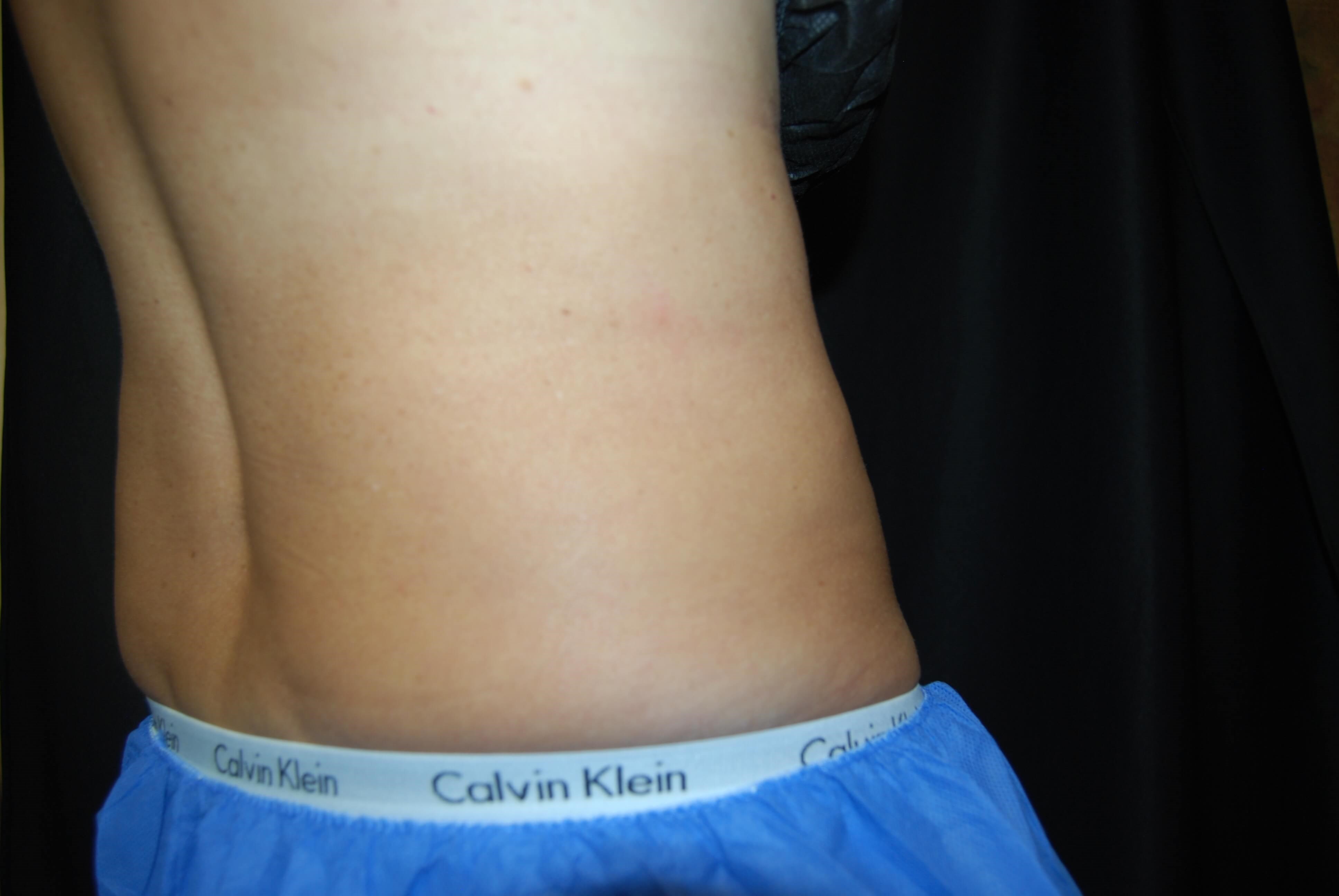 Coolsculpting Flanks After