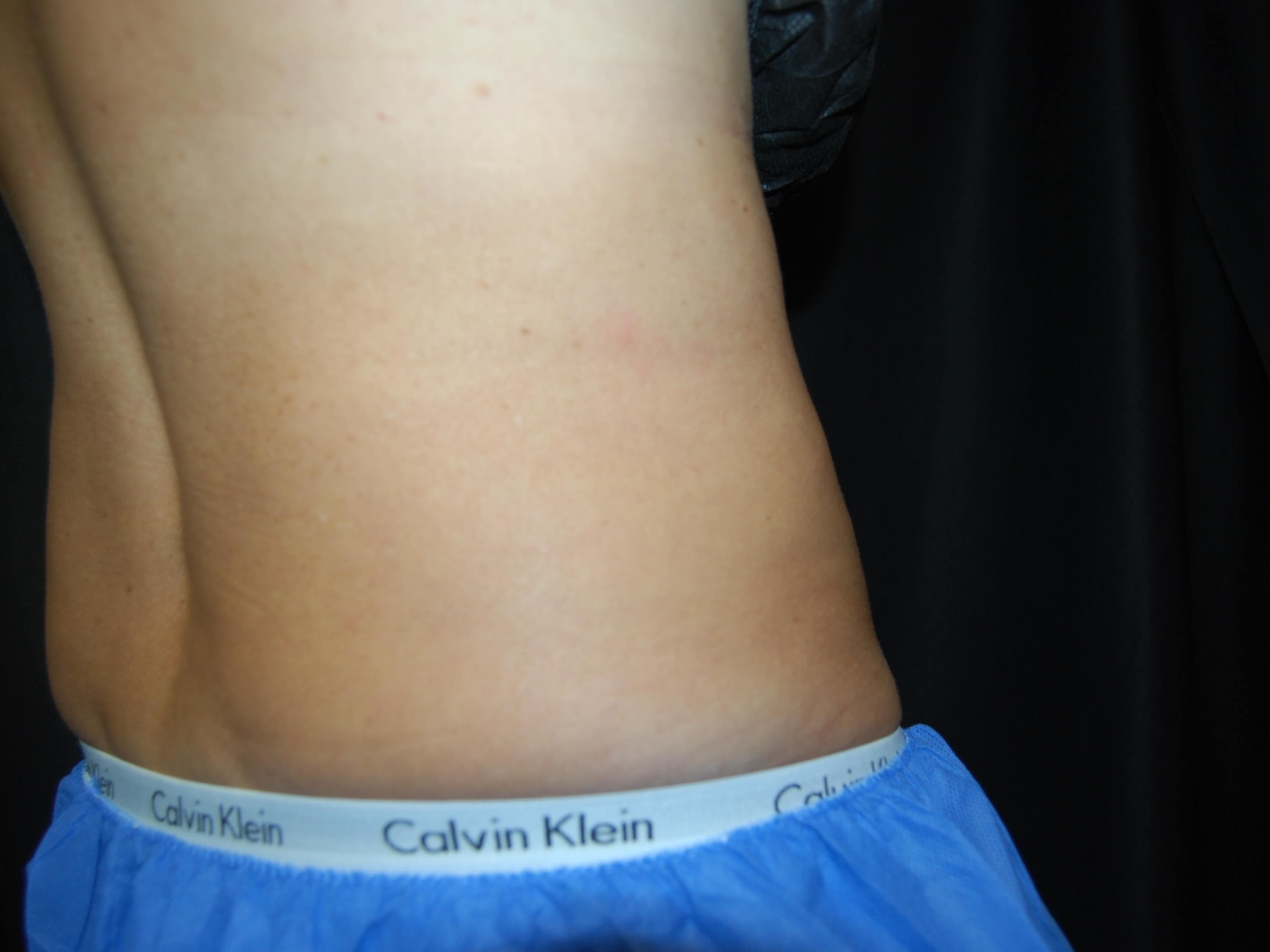 Coolsculpting Flanks After