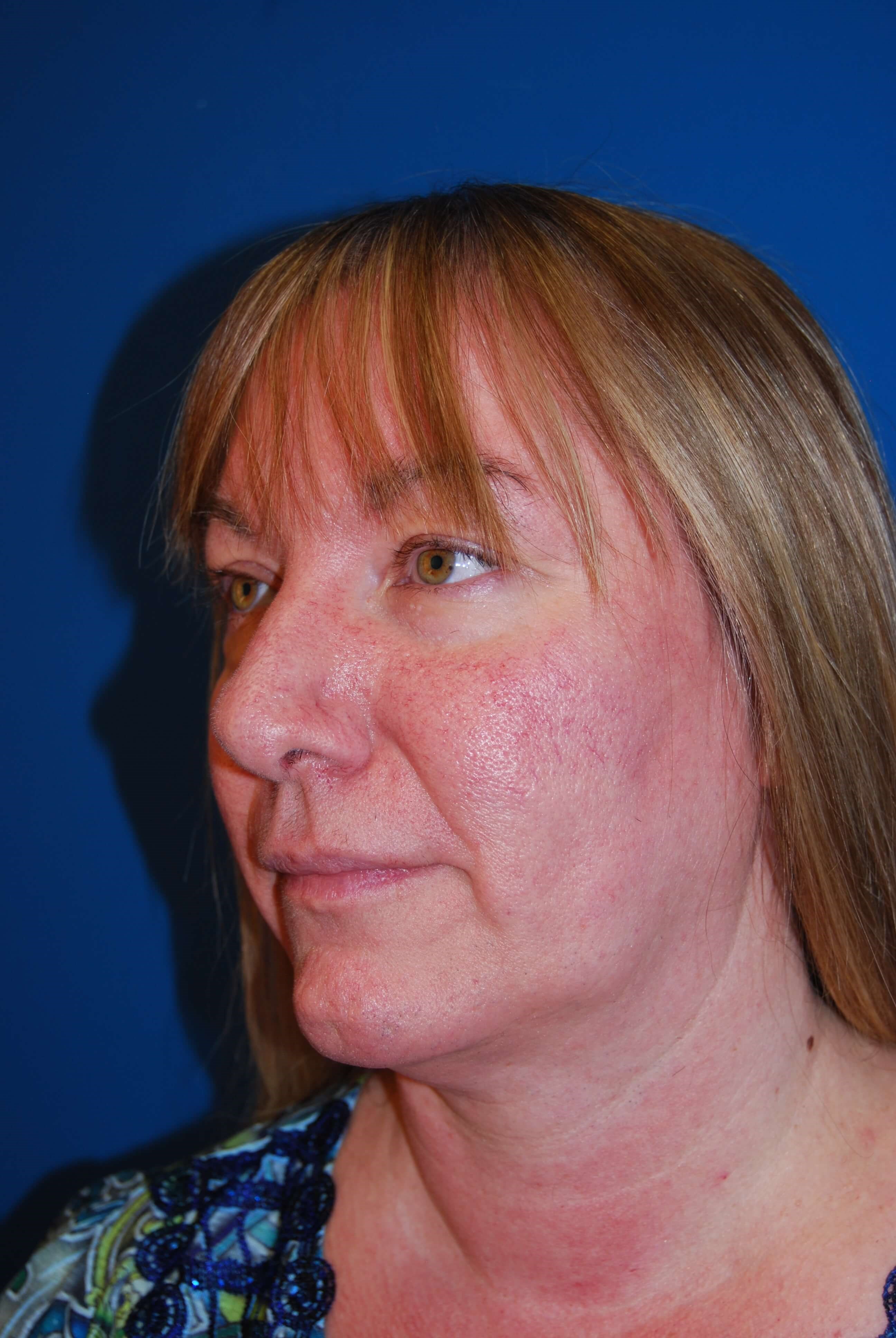 Broad Band Light Treatment Before