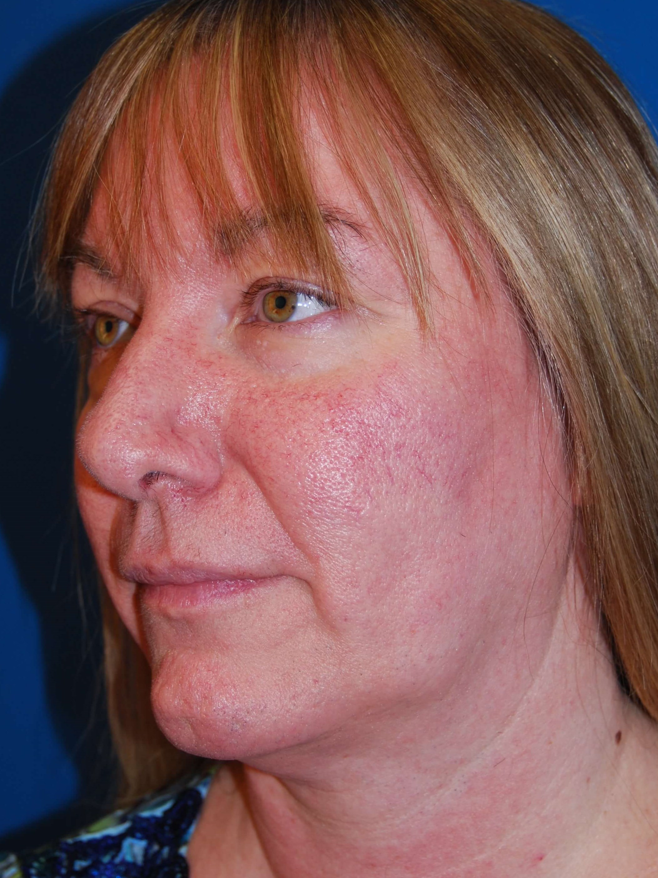 Broad Band Light Treatment Before