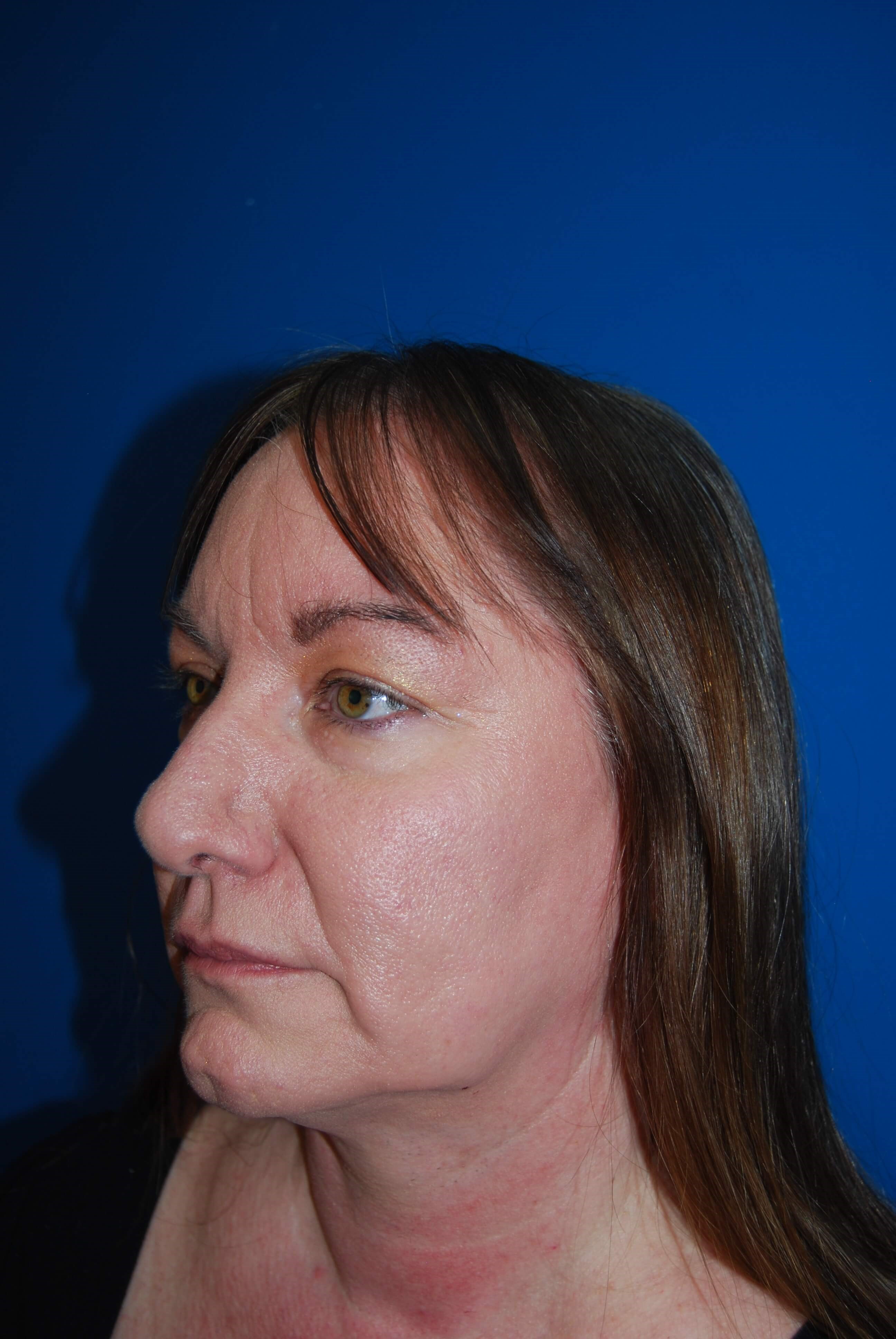 Broad Band Light Treatment After