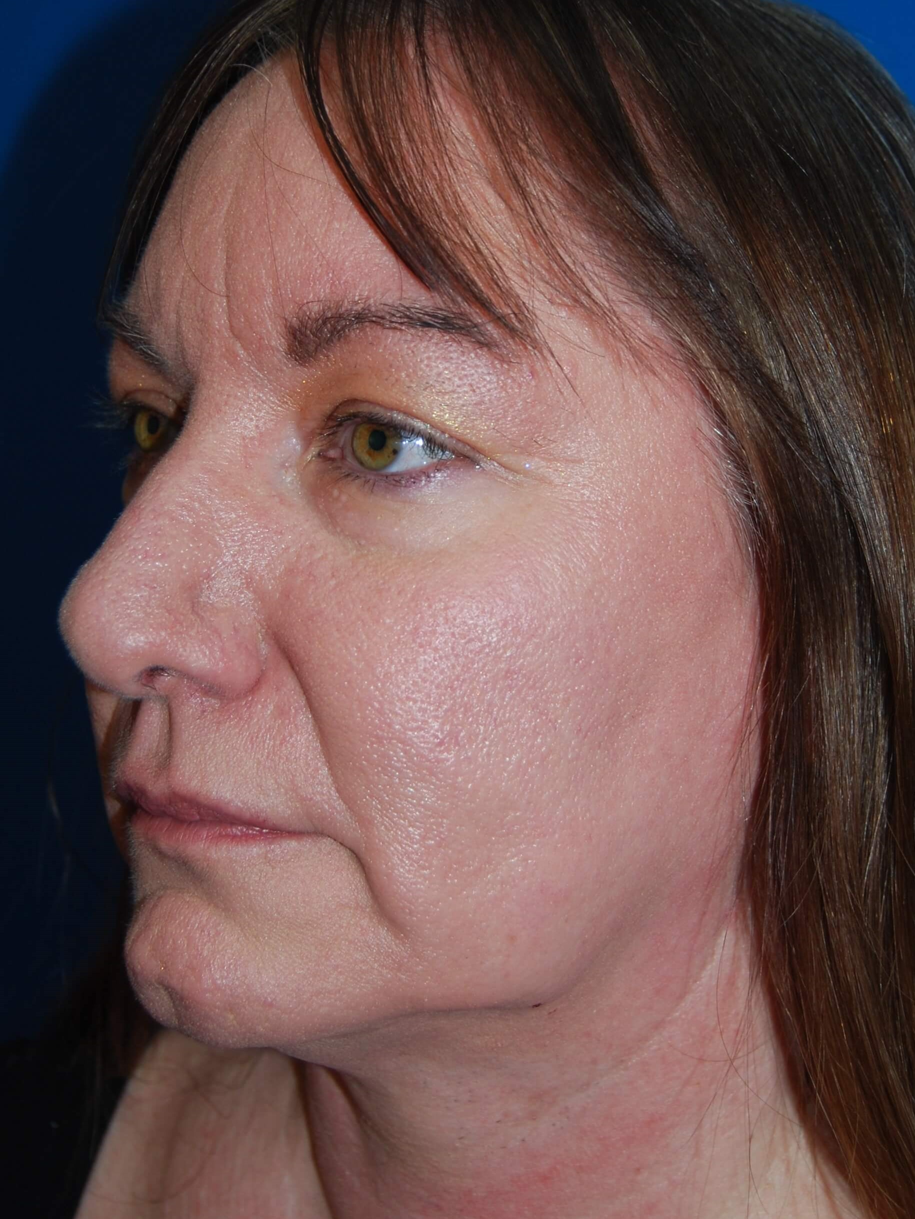 Broad Band Light Treatment After