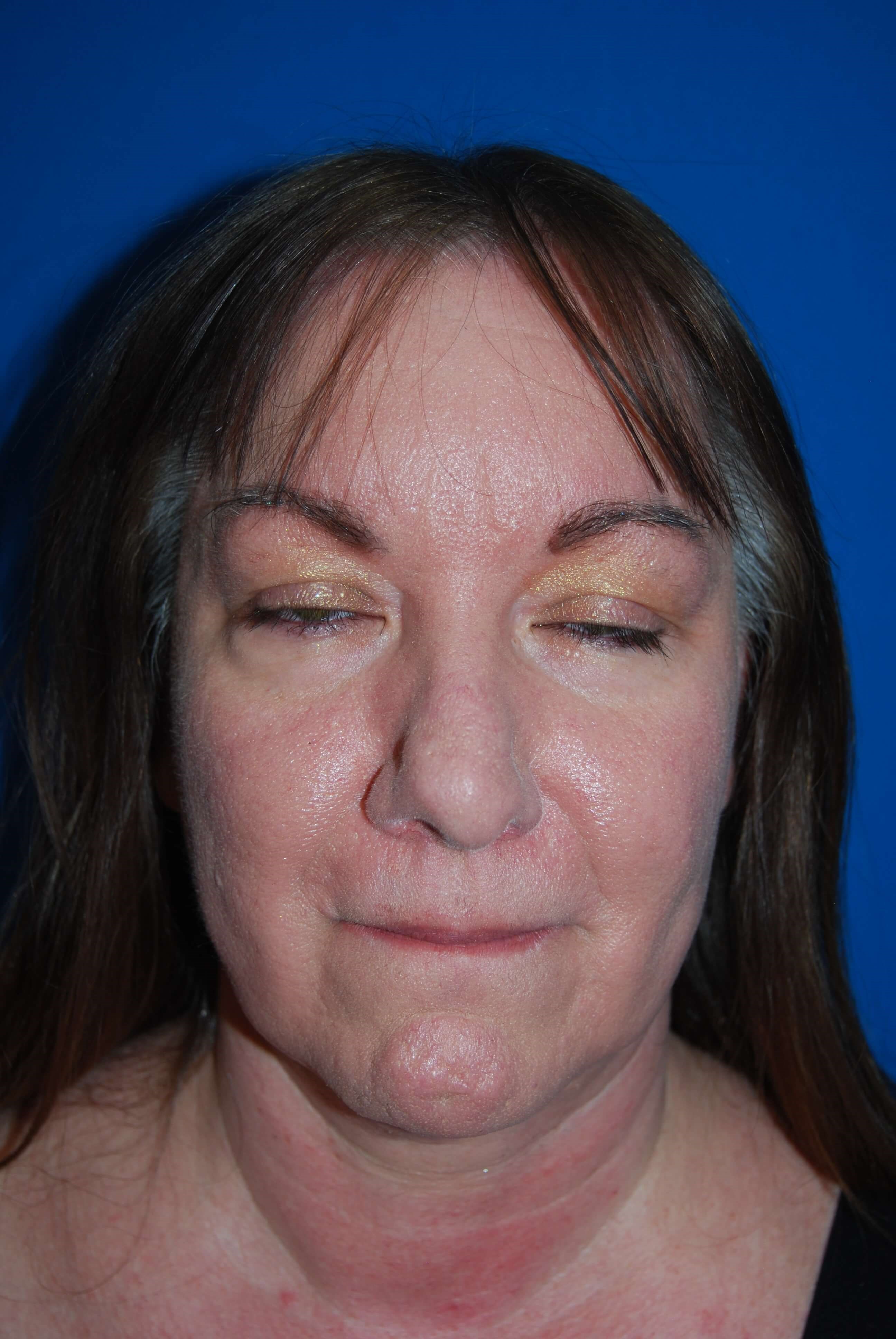 Broad Band Light Treatment After