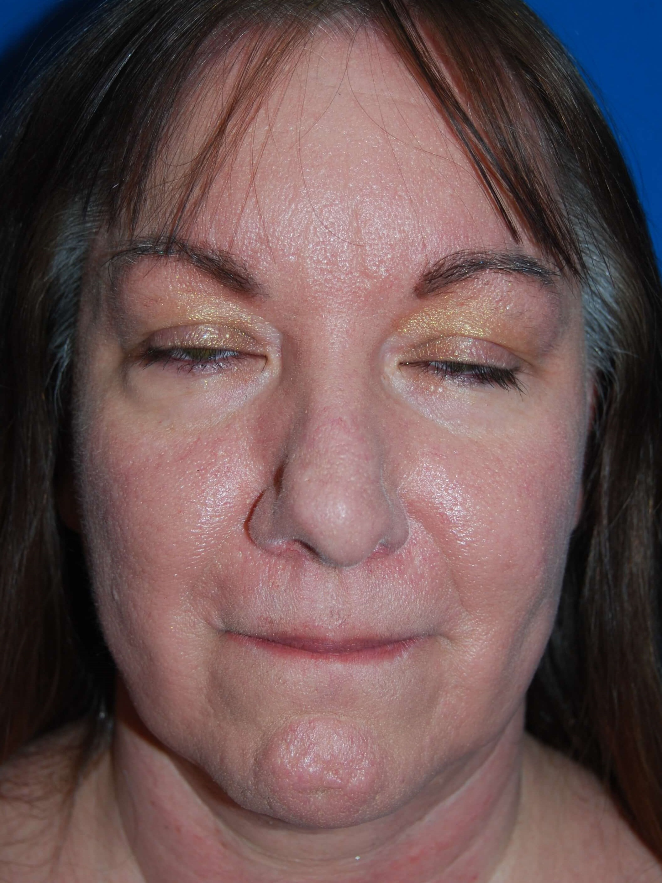 Broad Band Light Treatment After