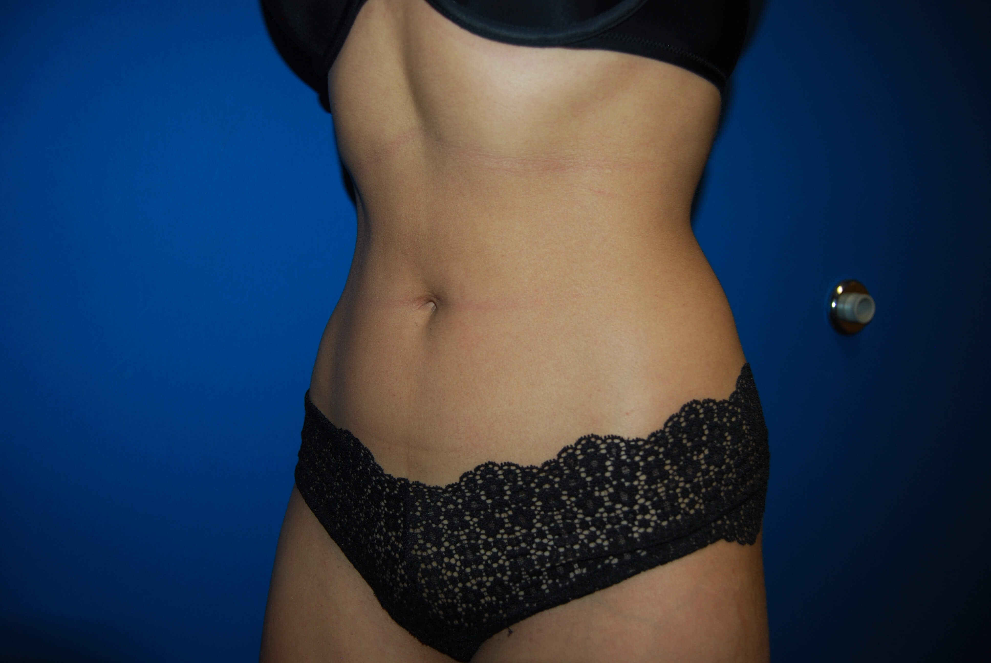 Oblique - Left After