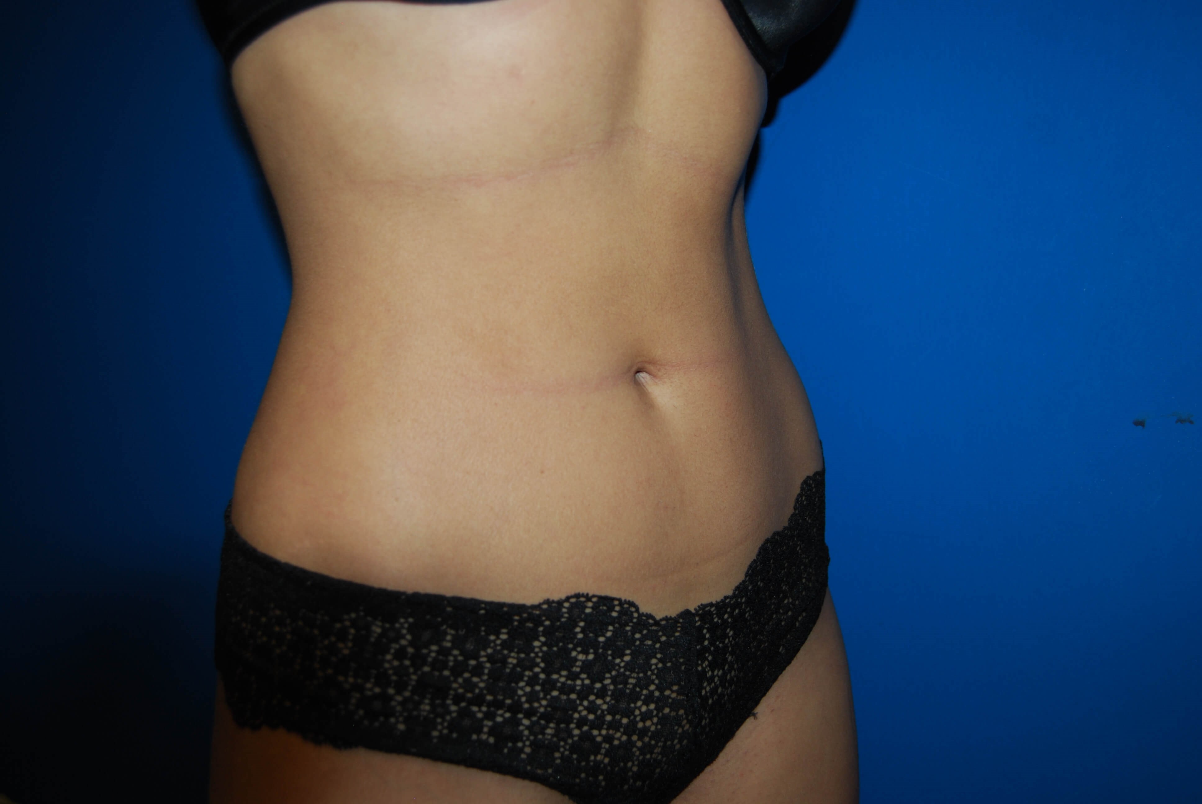 Oblique - Right After