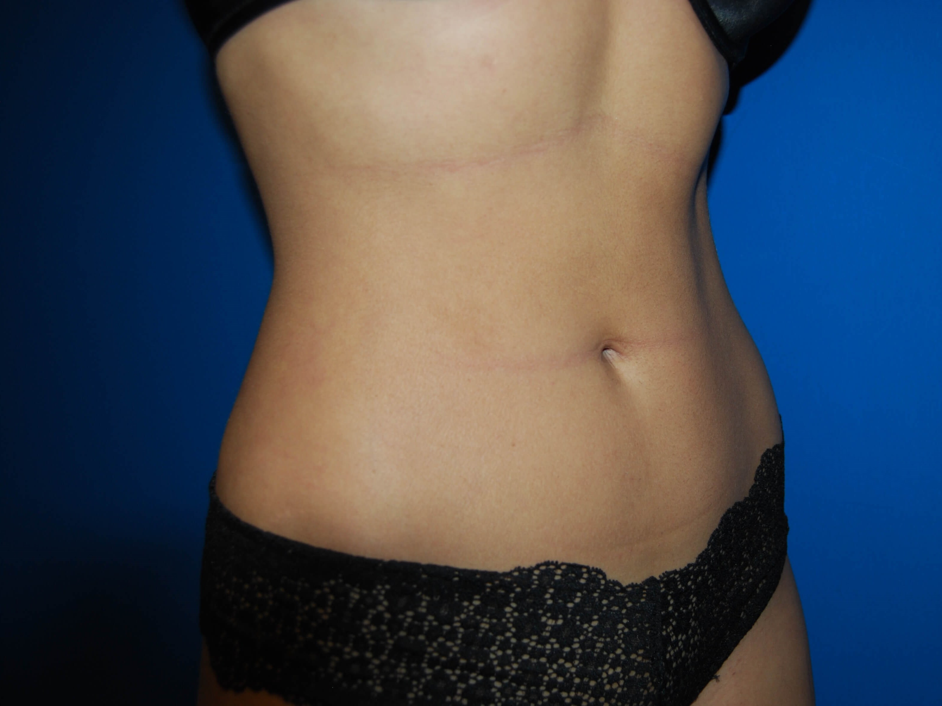 Oblique - Right After