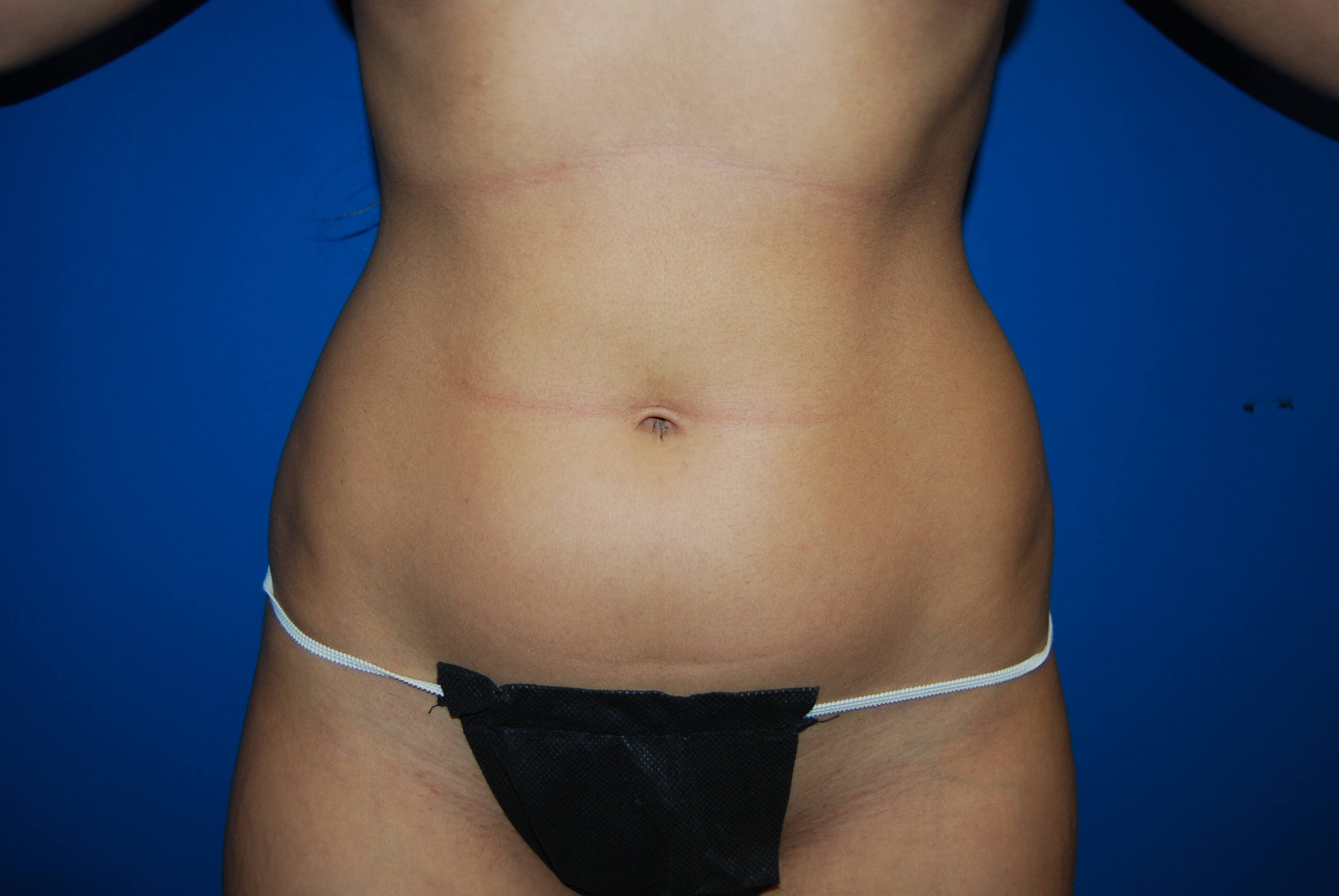 Front Before