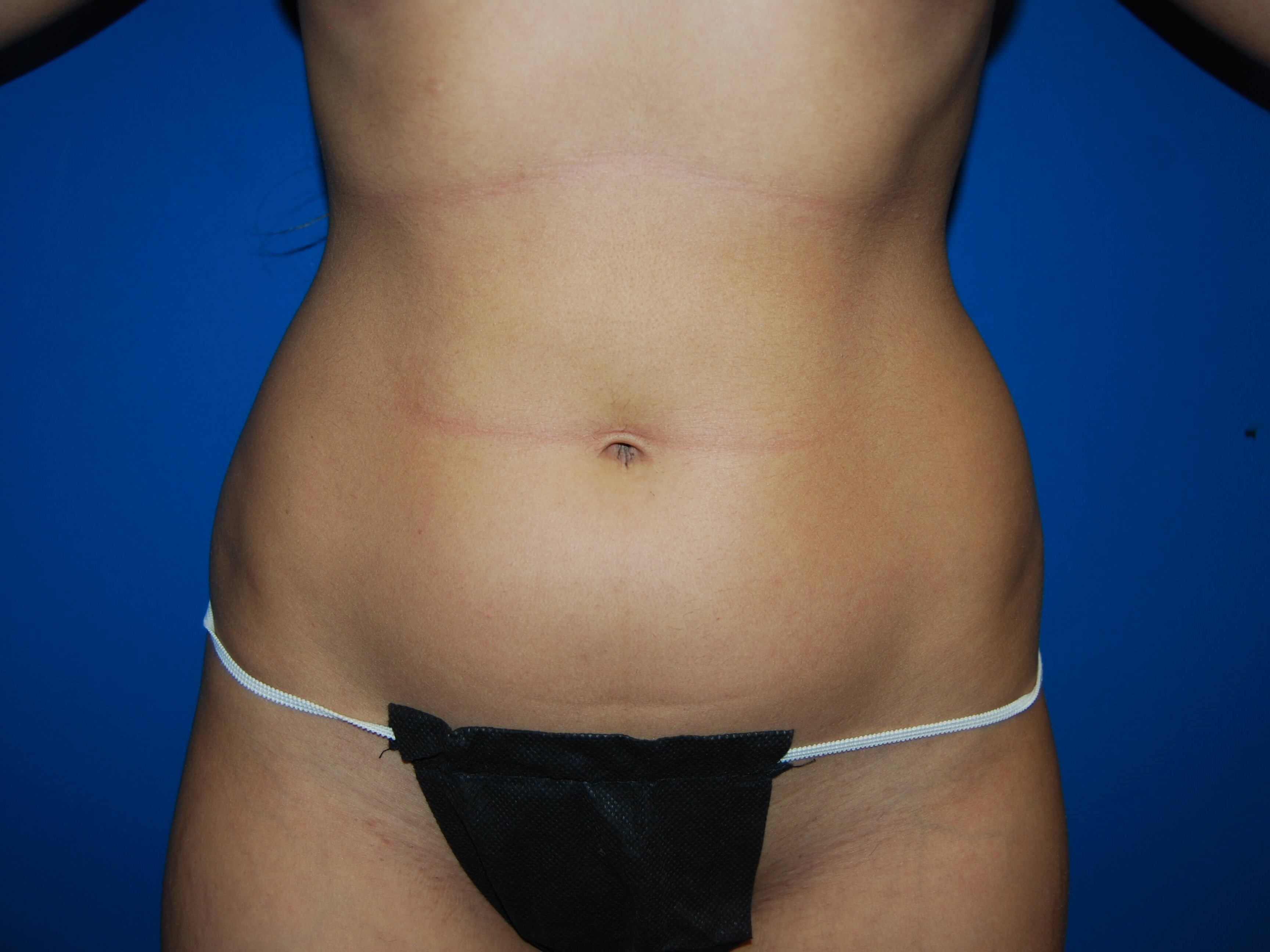 Front Before