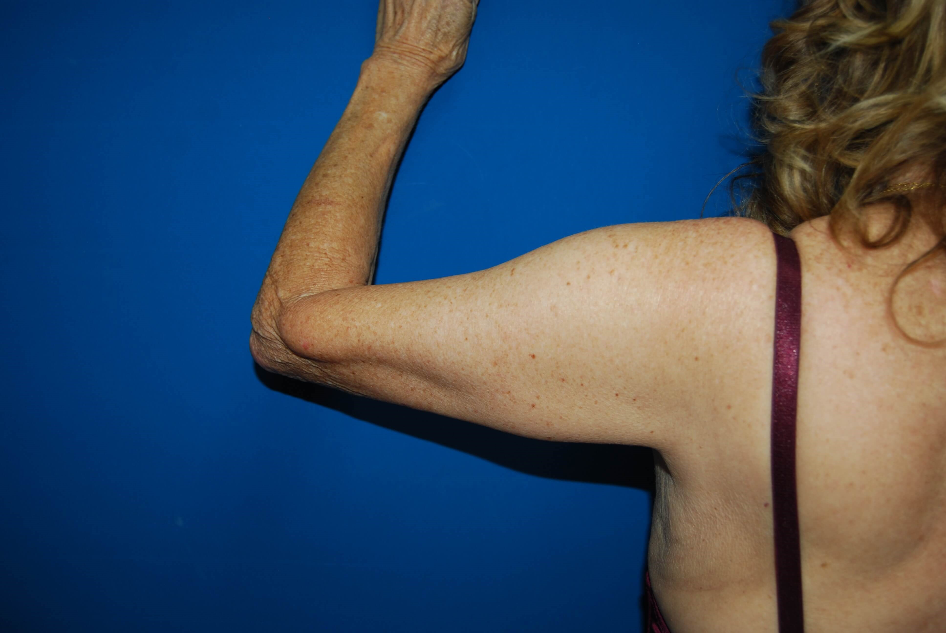 Outer View - Left After Arm Lift
