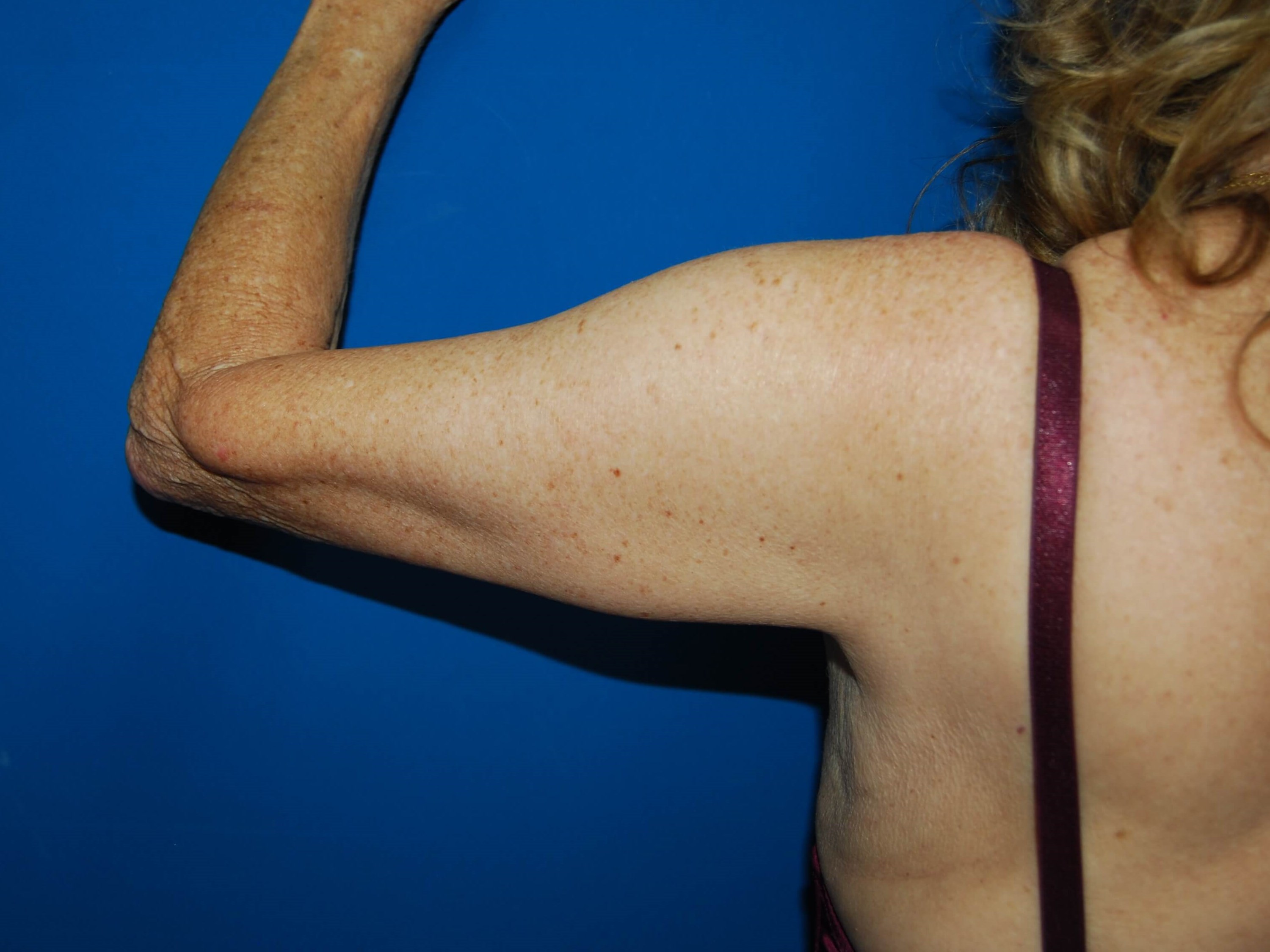 Outer View - Left After Arm Lift