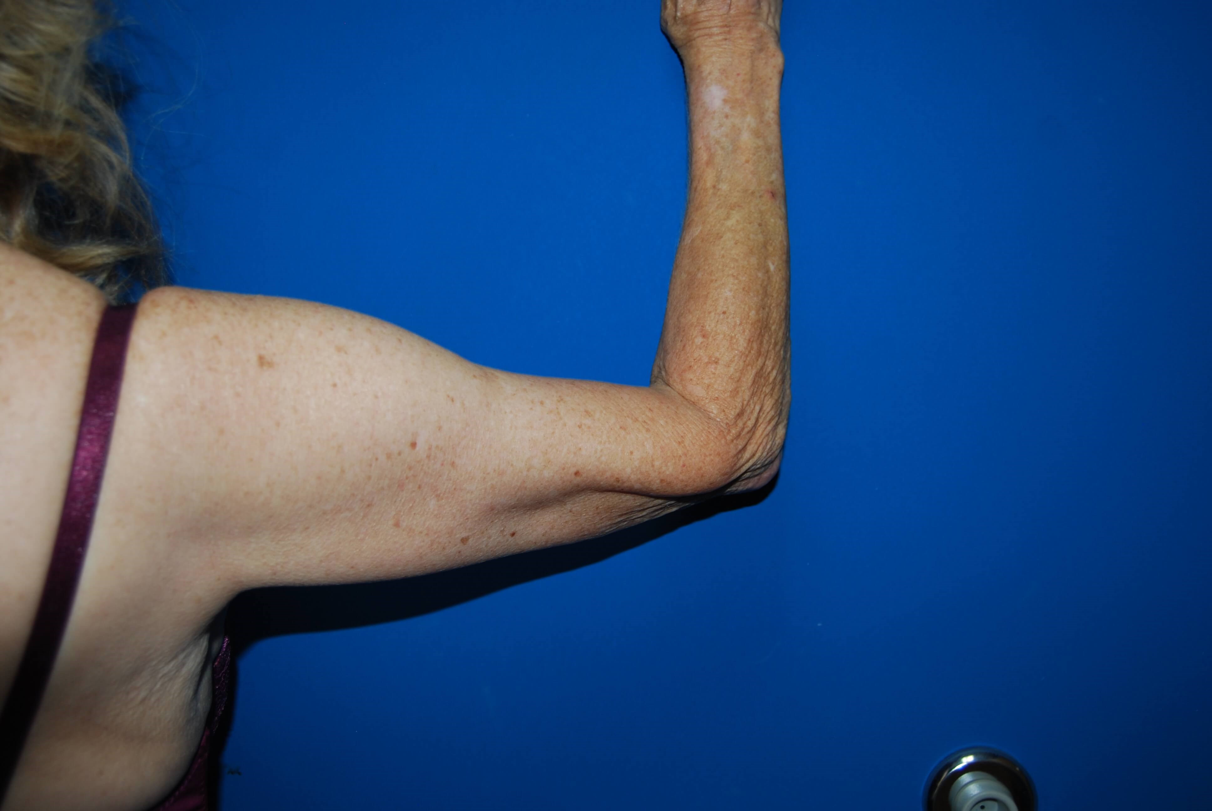 Outer View - Right After Arm Lift