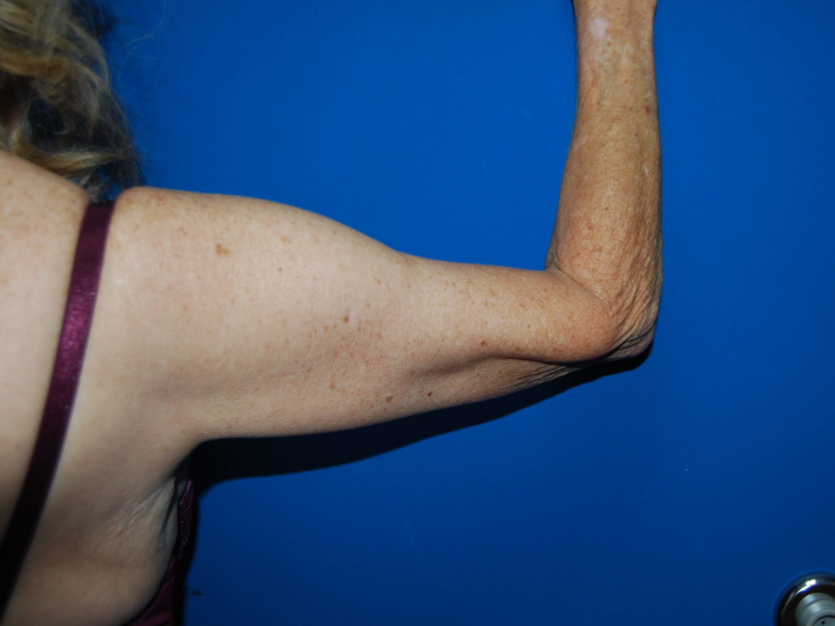 Outer View - Right After Arm Lift