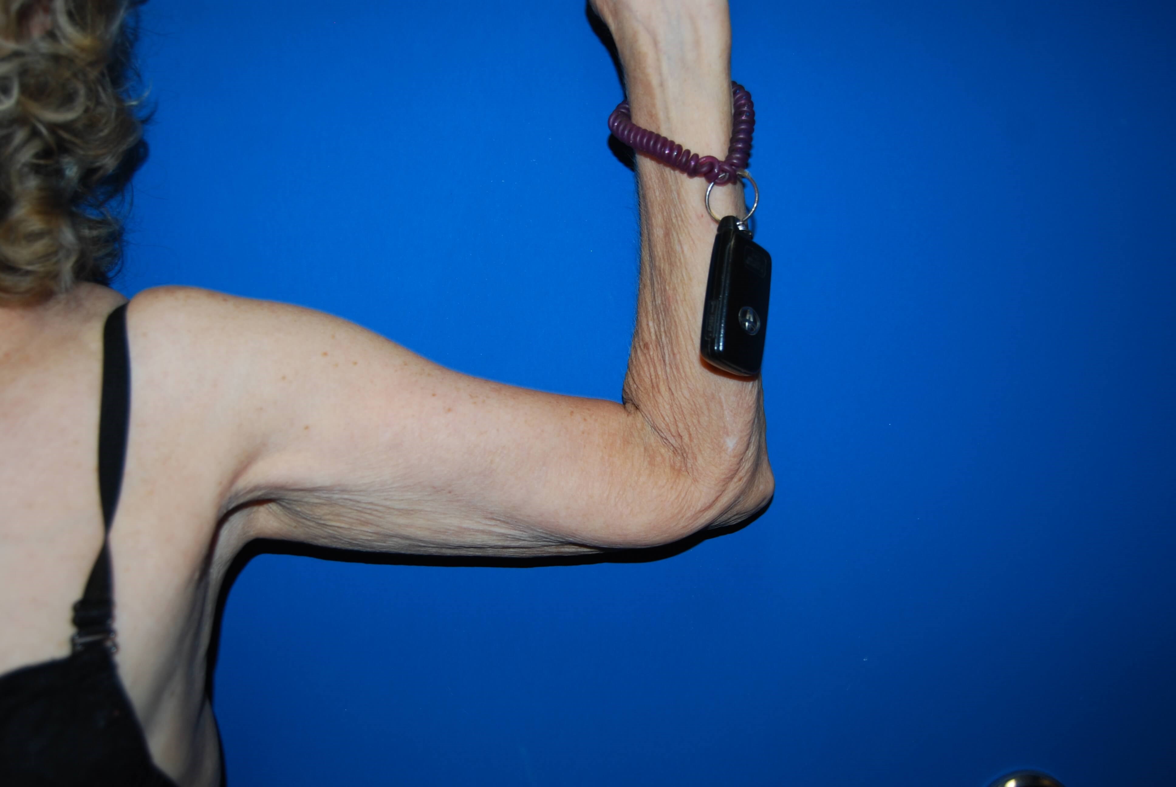 Inner View - Left Before Arm Lift
