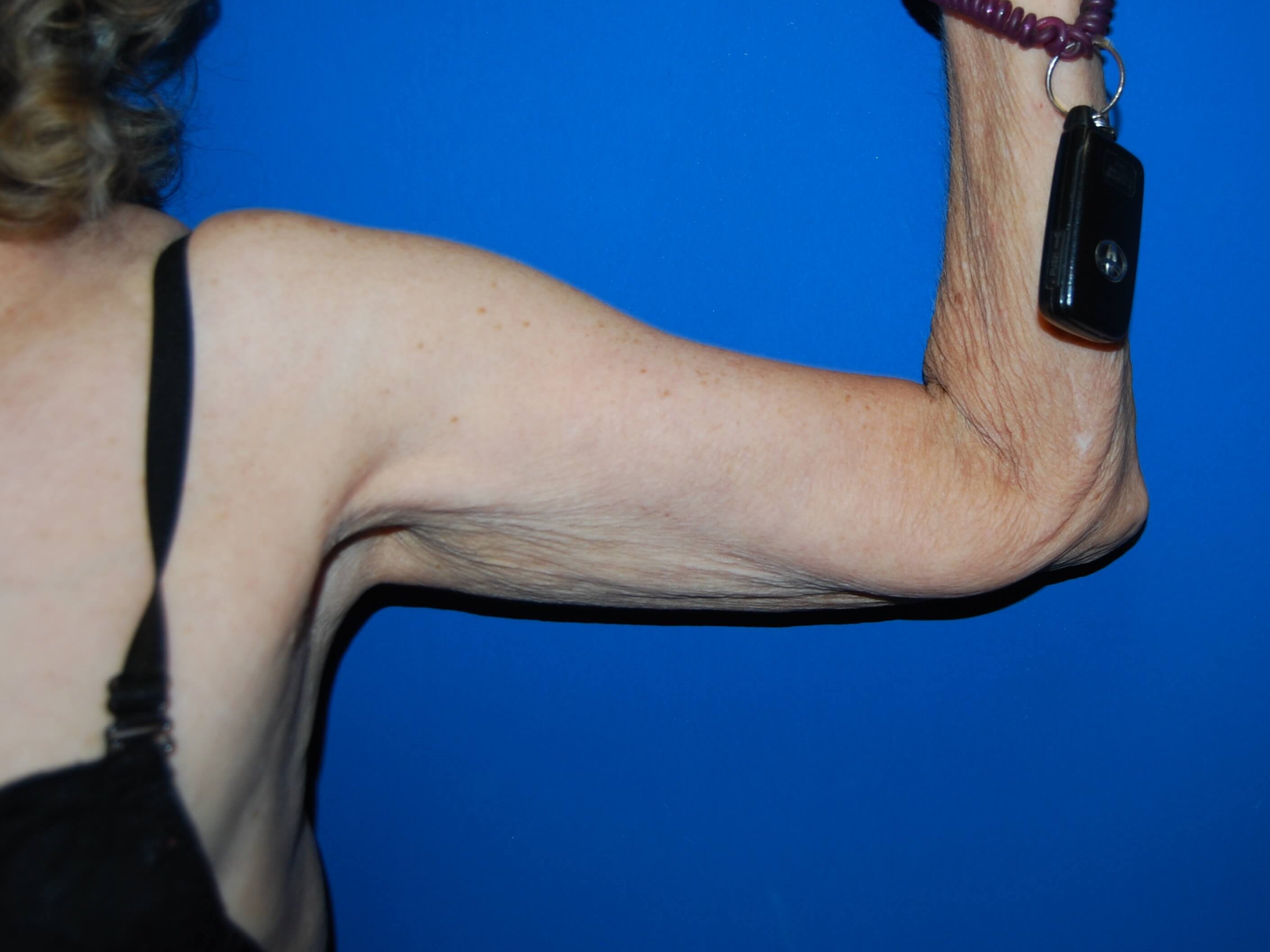 Inner View - Left Before Arm Lift