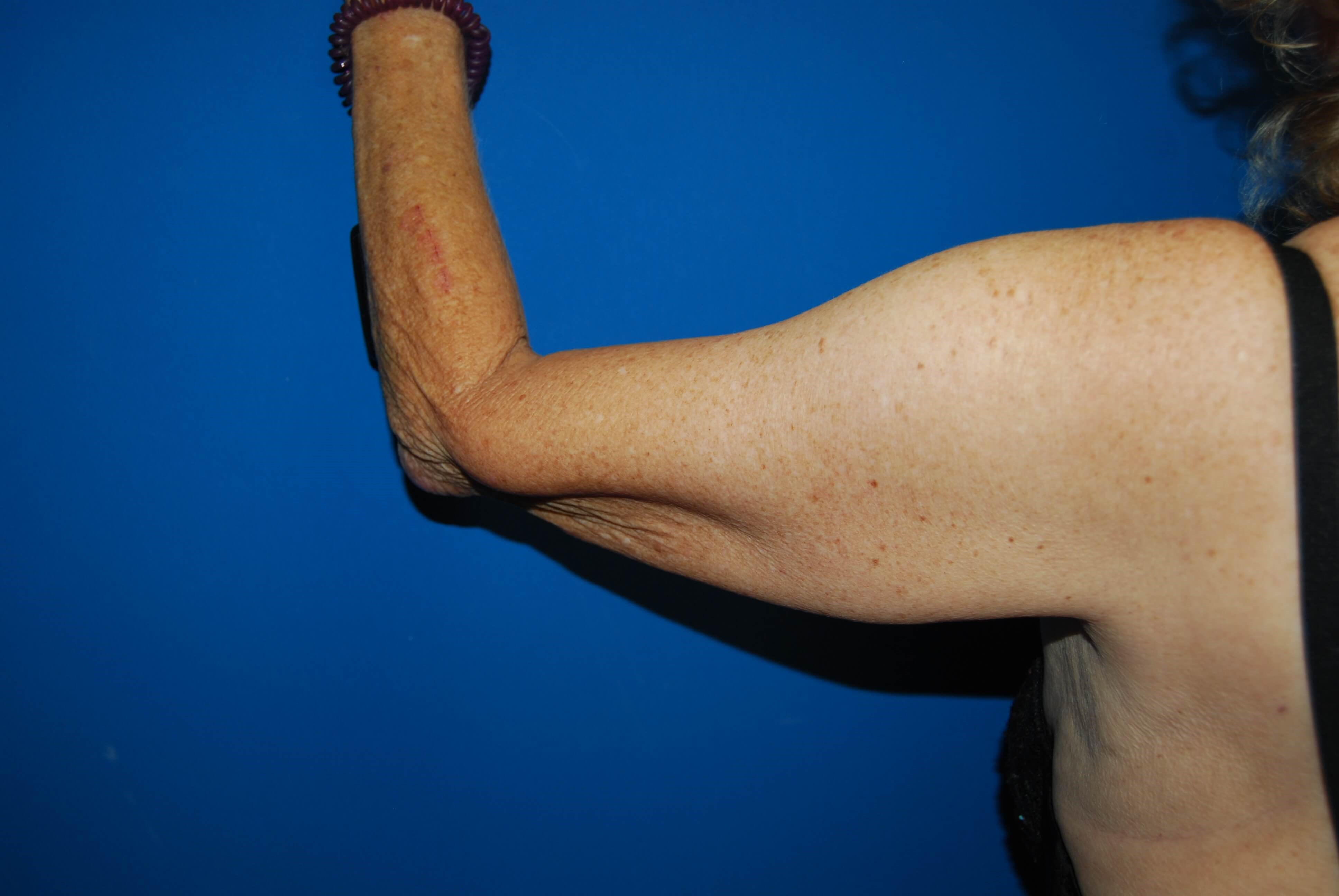 Outer View - Left Before  Arm Lift
