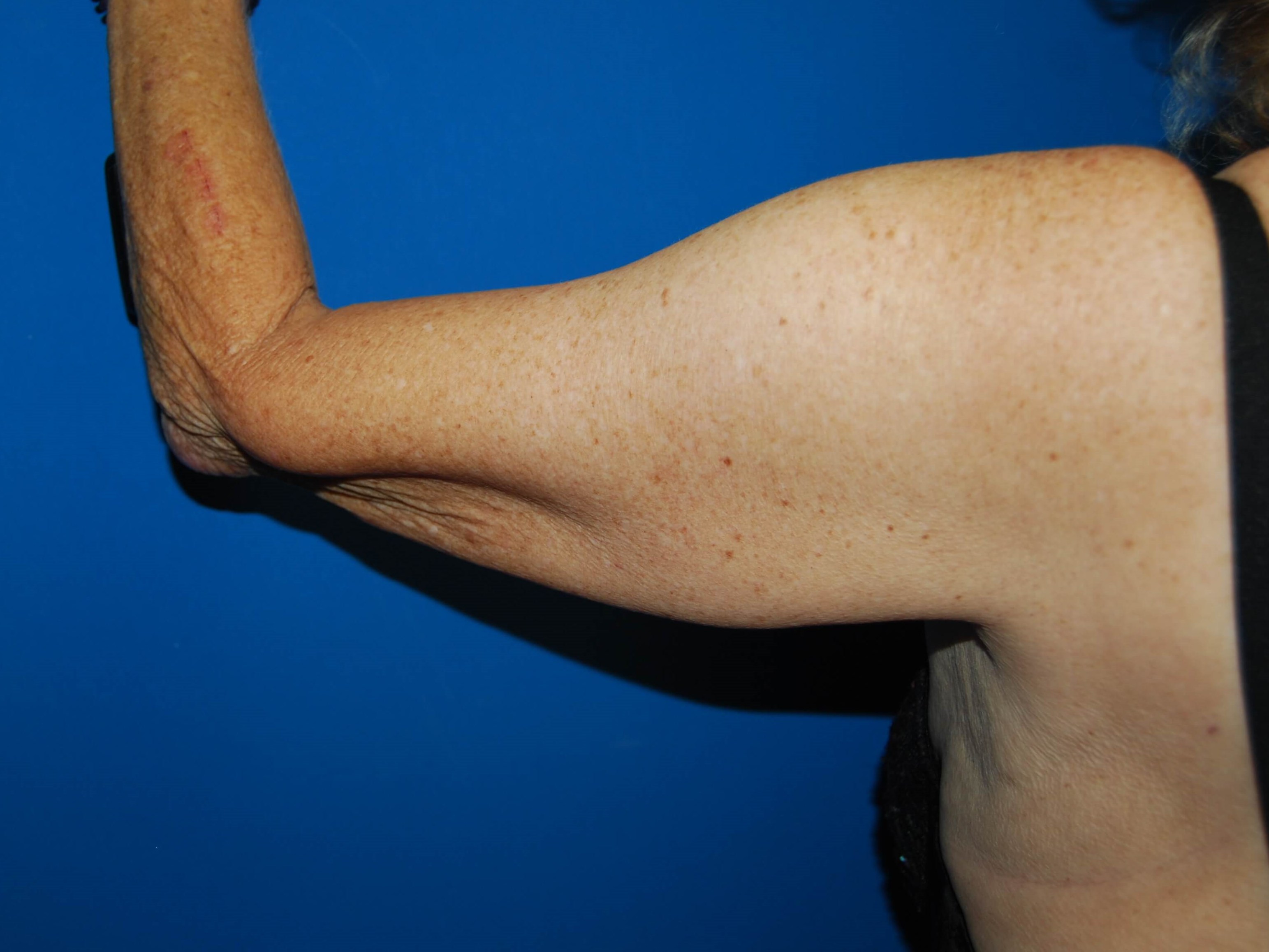 Outer View - Left Before  Arm Lift