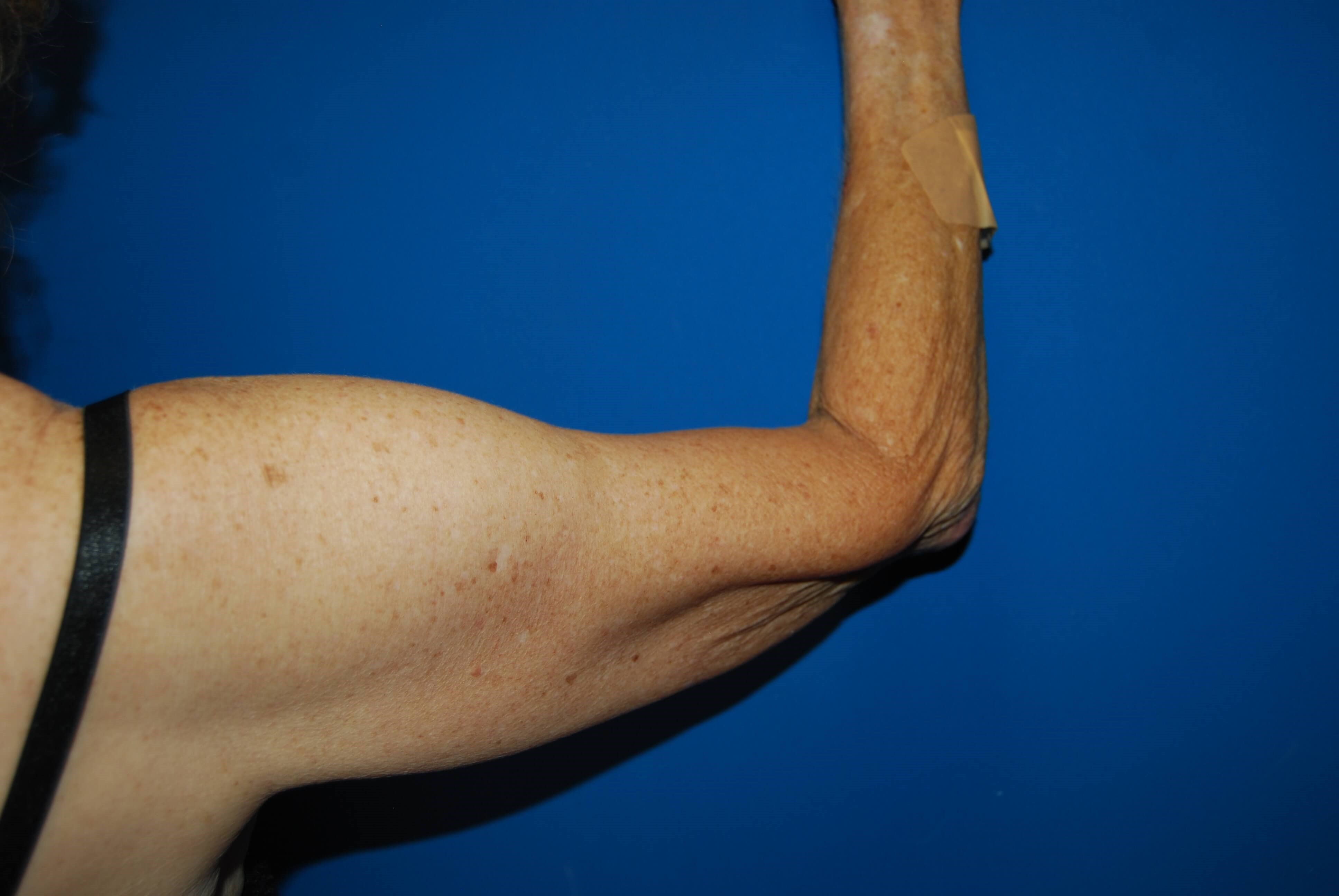 Outer View - Right Before Arm Lift