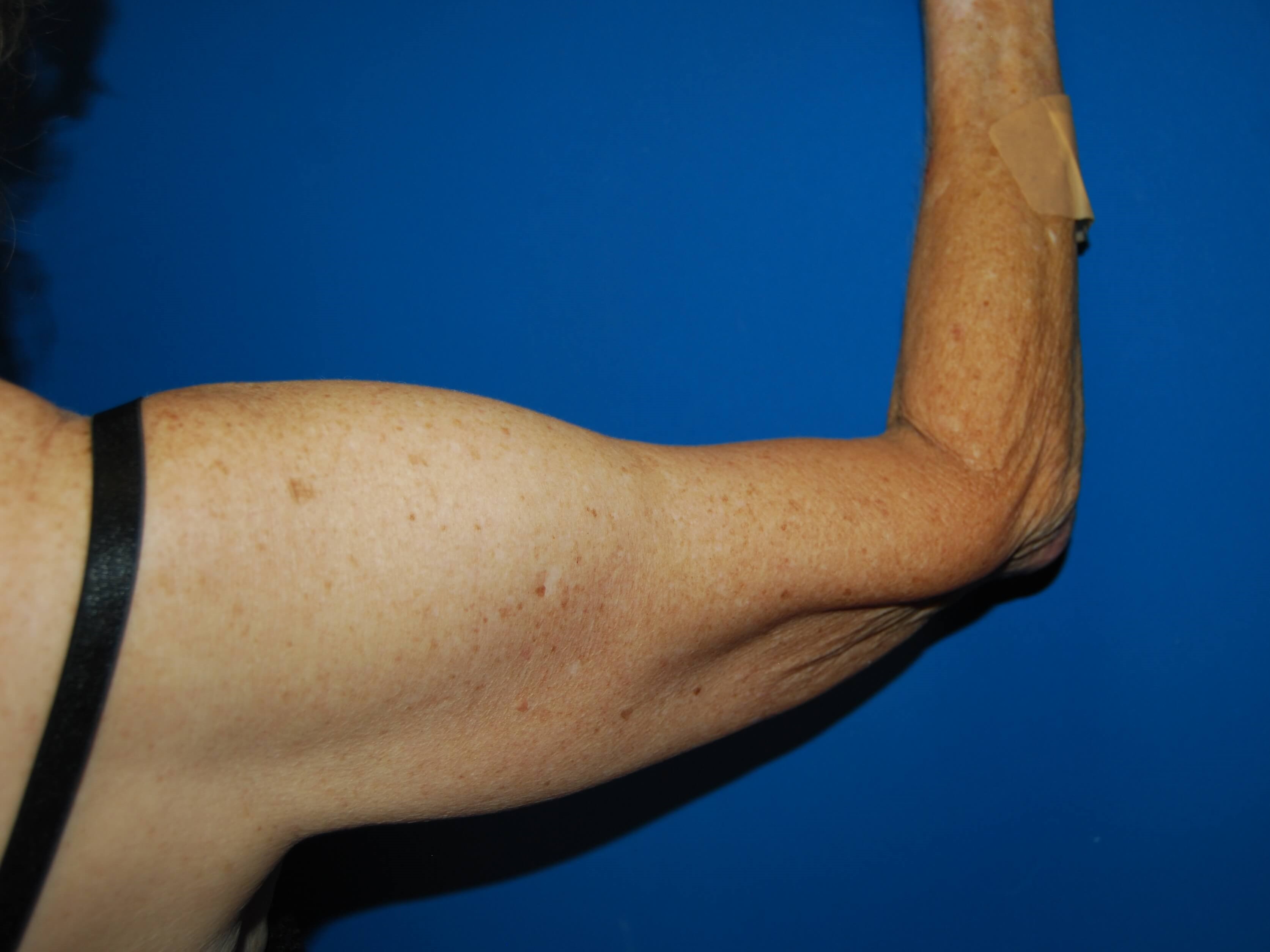 Outer View - Right Before Arm Lift