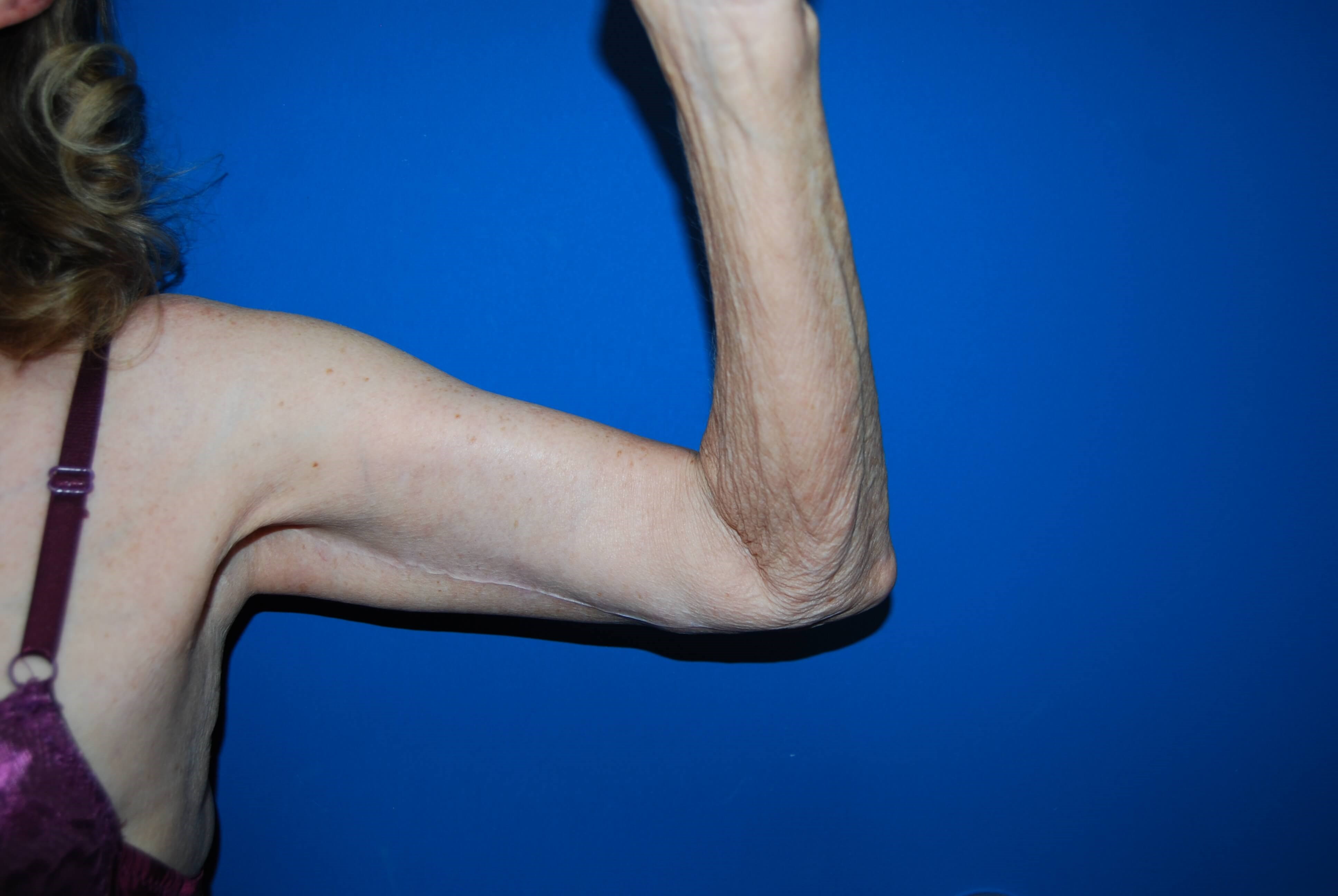 Inner View - Left After Arm Lift