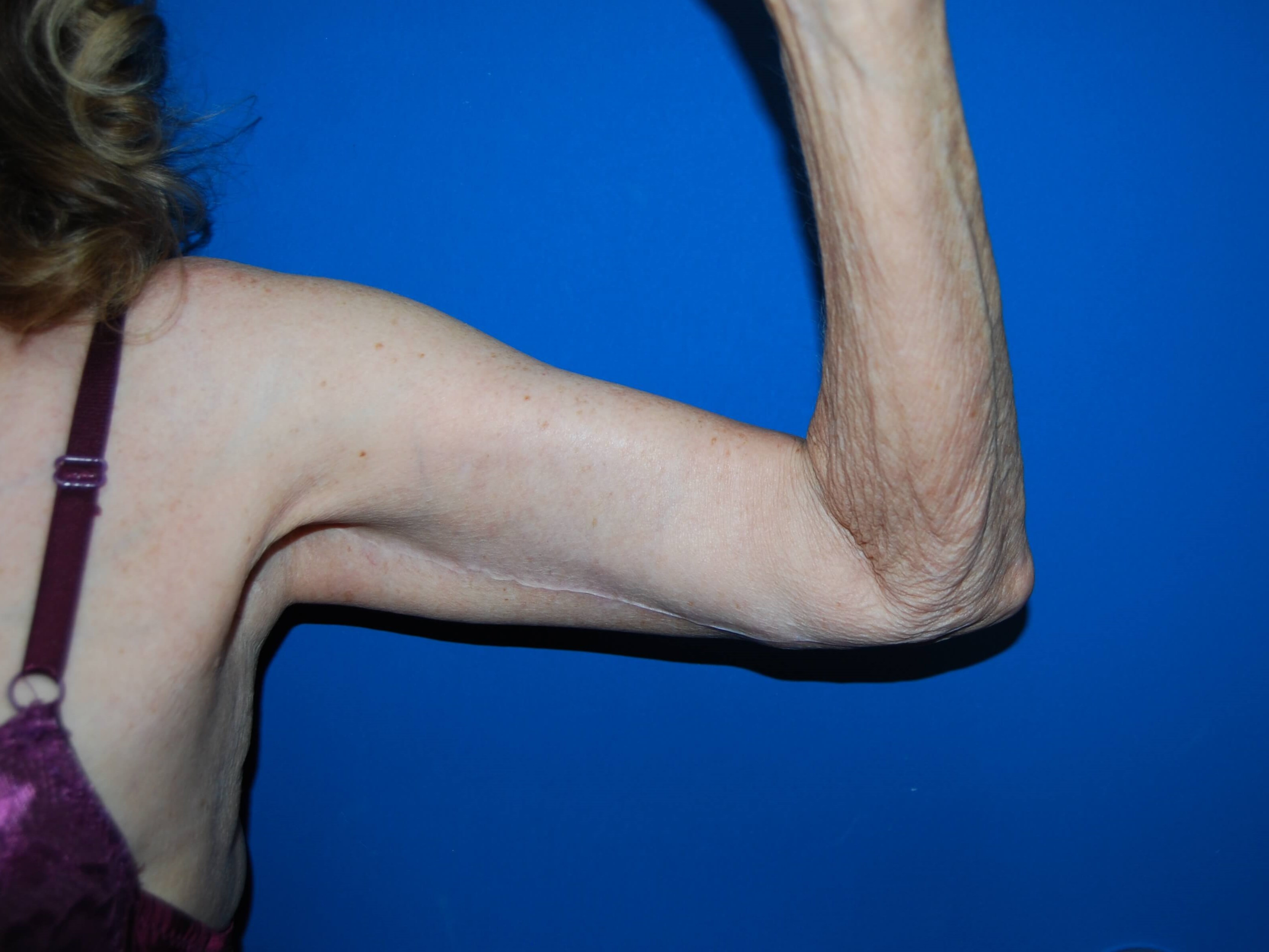 Inner View - Left After Arm Lift