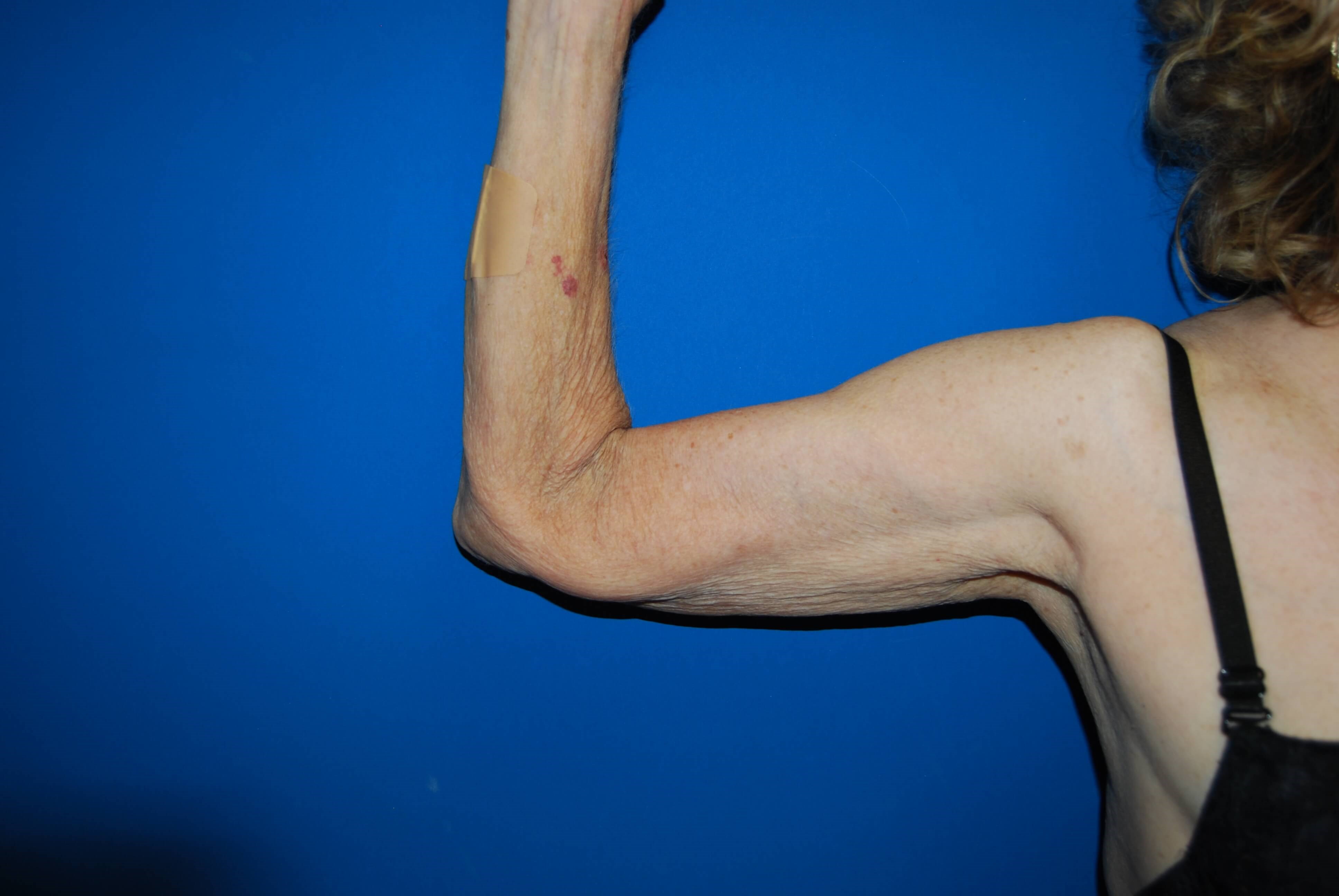 Inner View - Right Before Arm Lift