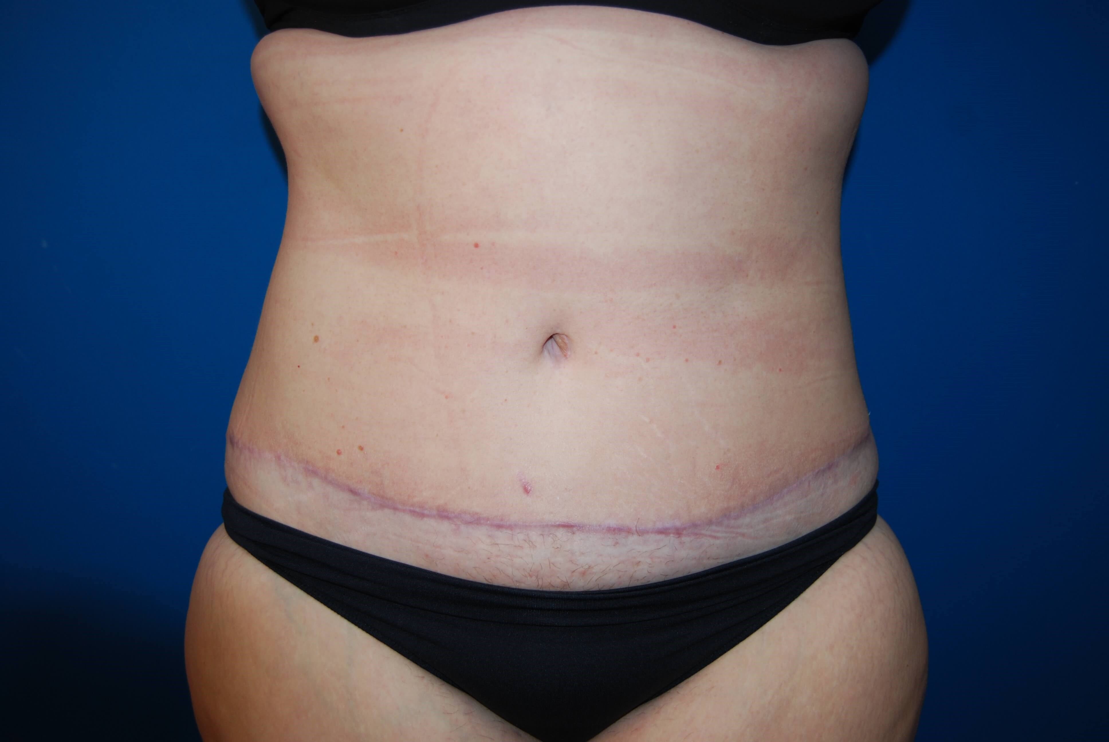Tummy Tuck St. Pete After