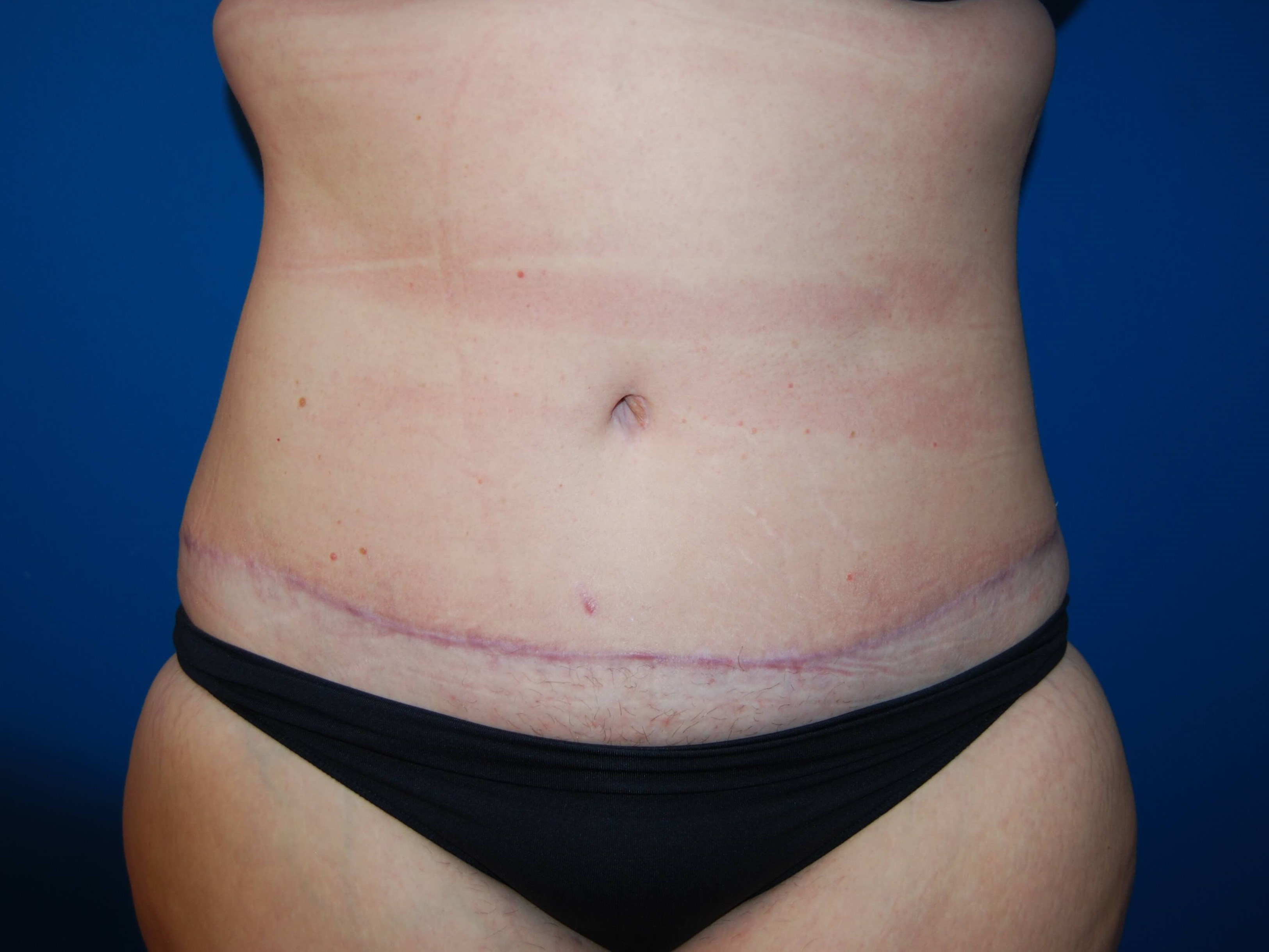 Tummy Tuck St. Pete After