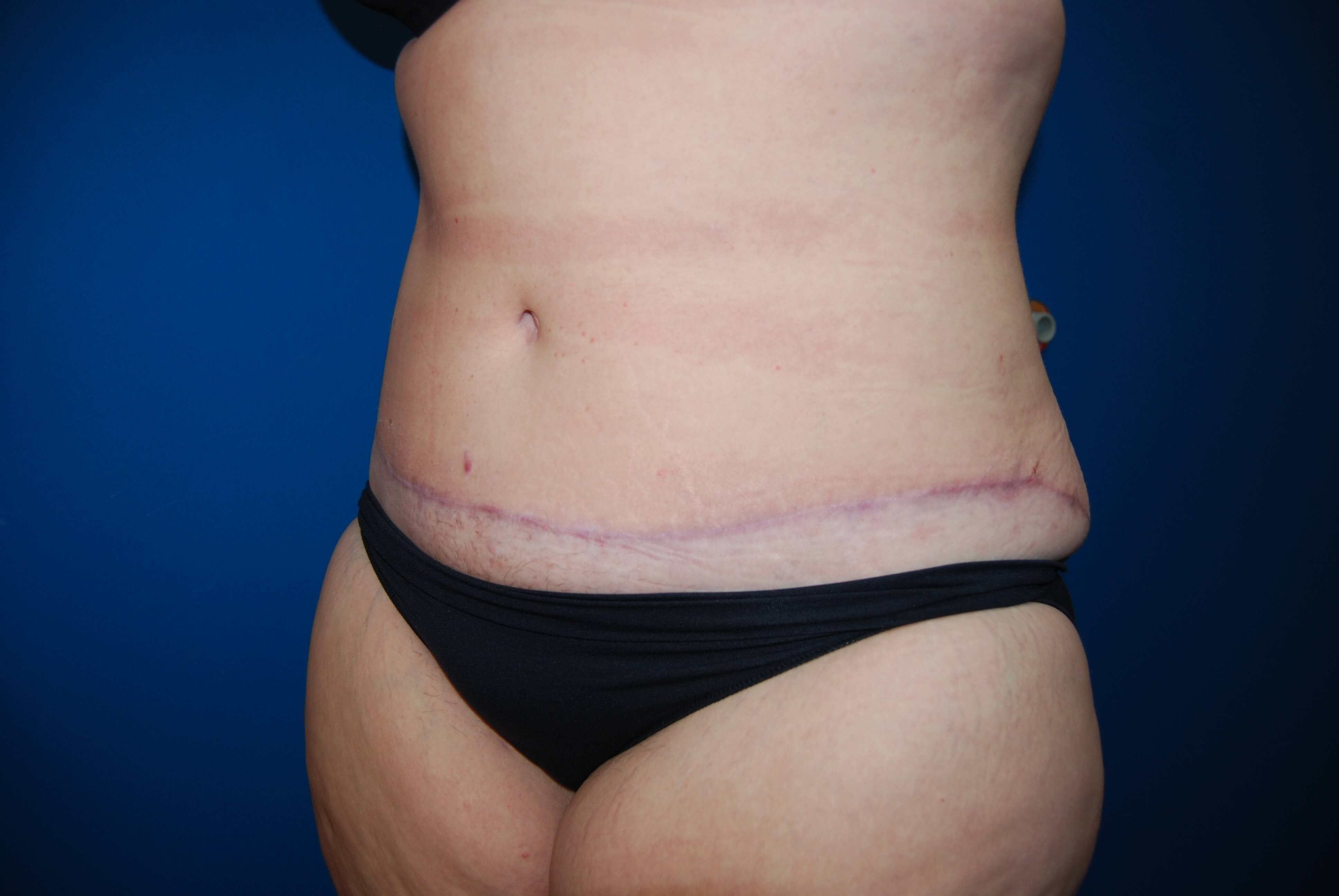 Abdominoplasty St. Petersburg After