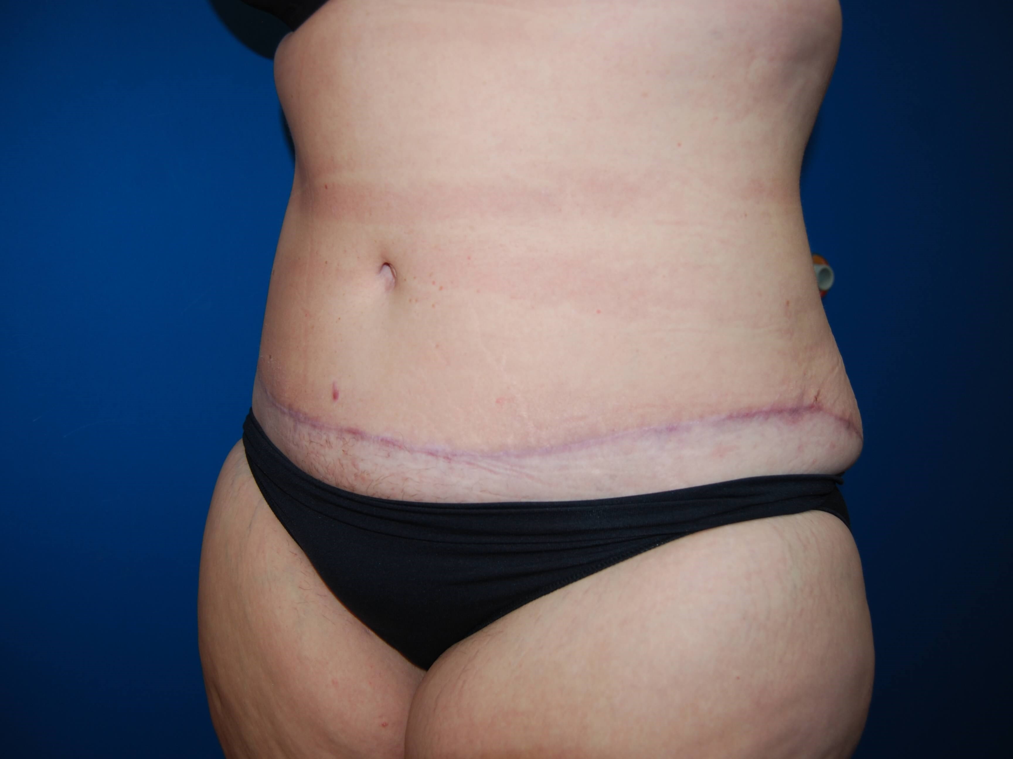 Abdominoplasty St. Petersburg After