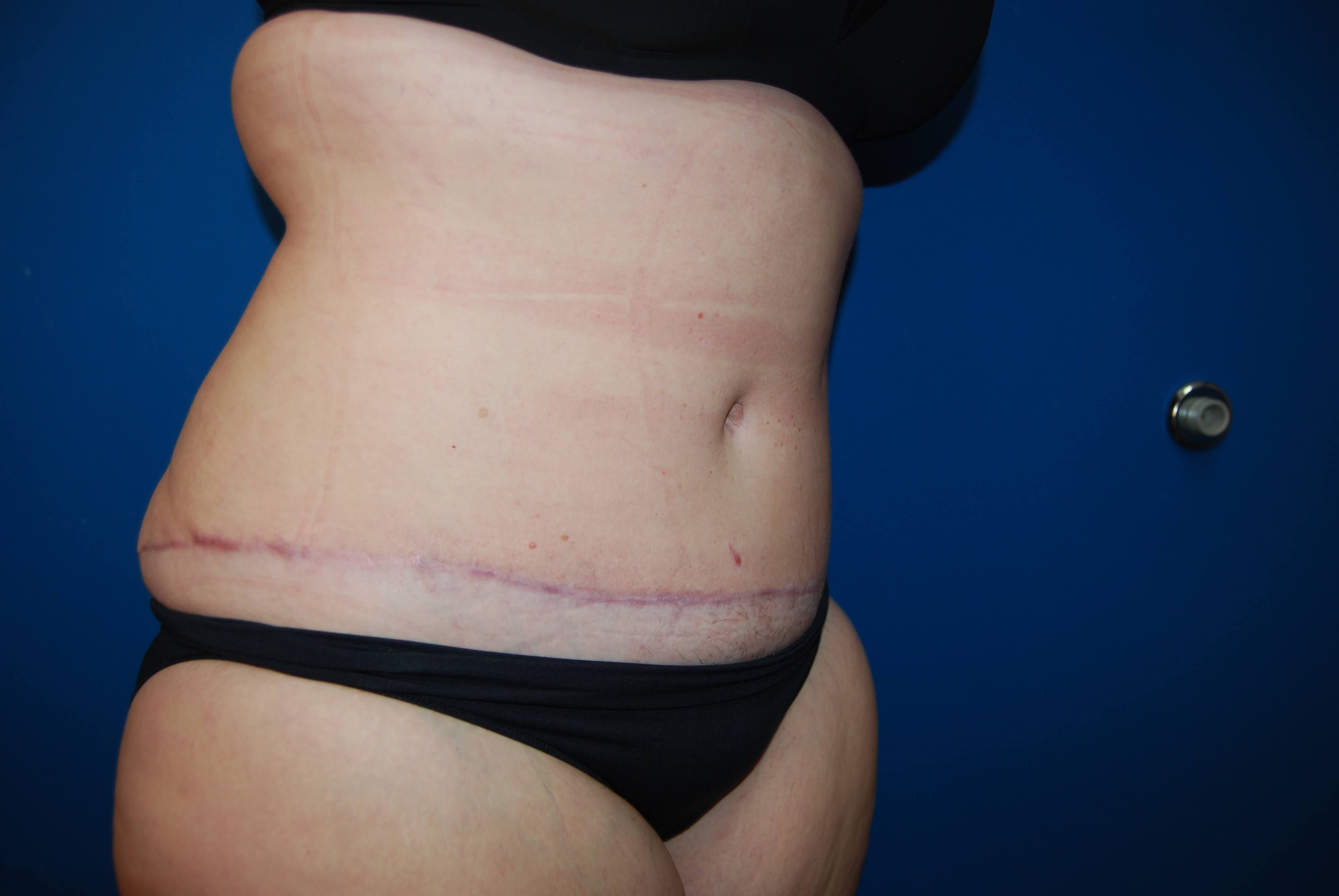 Extended Abdominoplasty Tampa After